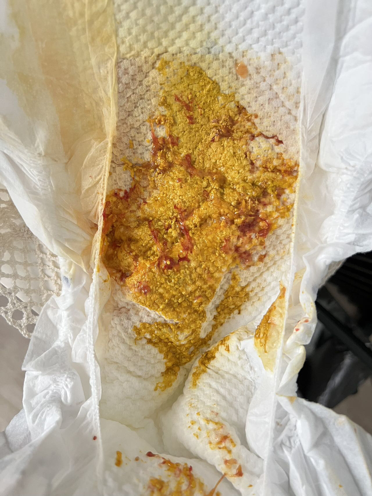 当天立刻停了母乳,喝奶粉,24小时内大便次数为9次,感觉是有点腹泻