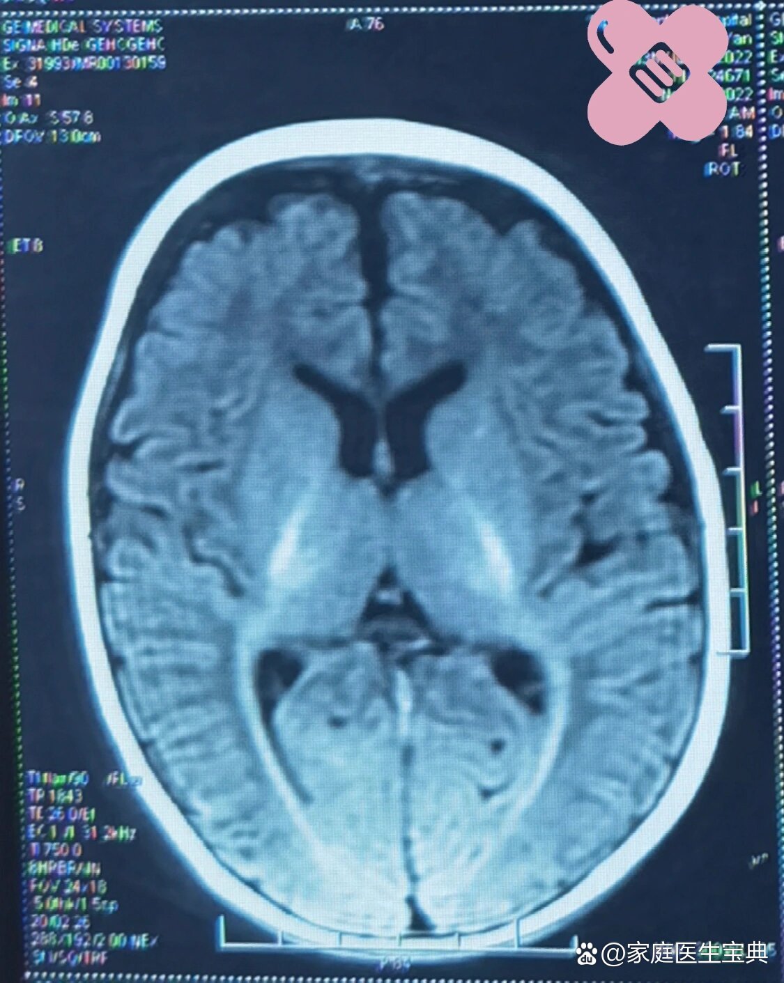 早产儿|这张头颅mri有什么问题?