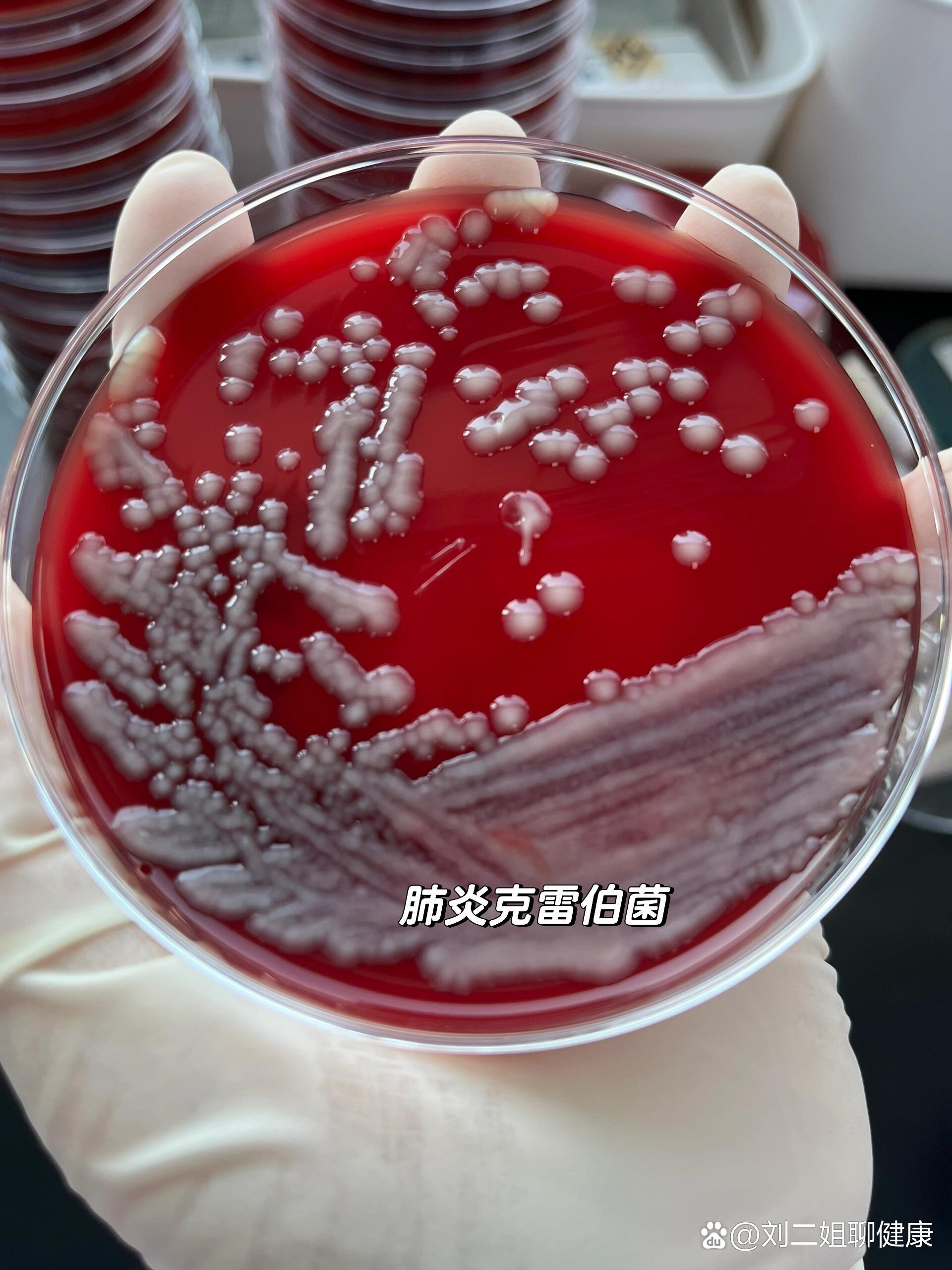  p>肺炎克雷伯菌(阴杆) br>属肠杆菌科,革兰阴性短粗杆菌(阴杆).