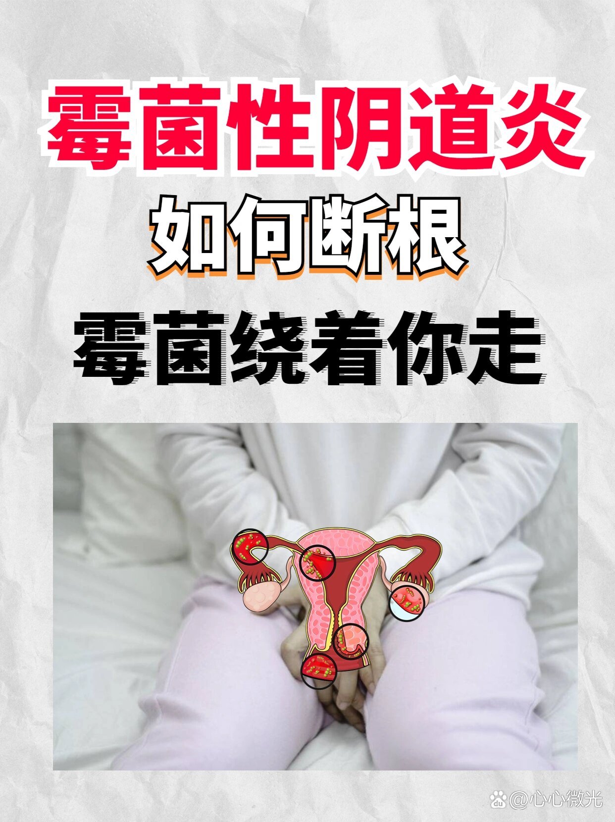 让霉菌绕着你走 br>9595 br>霉菌性阴道炎,是女性阴道炎里常见的