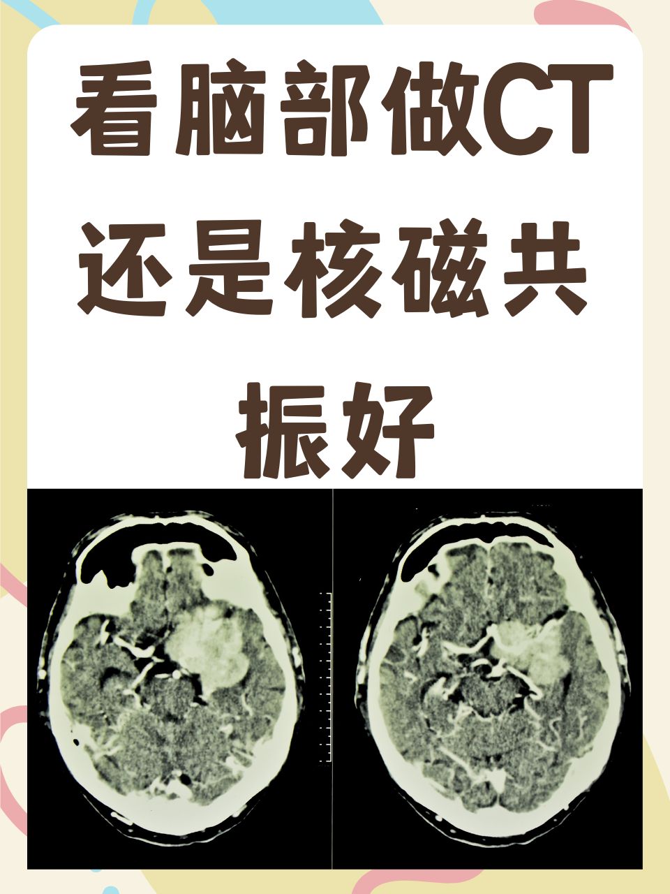 看脑部做CT还是核磁共振好