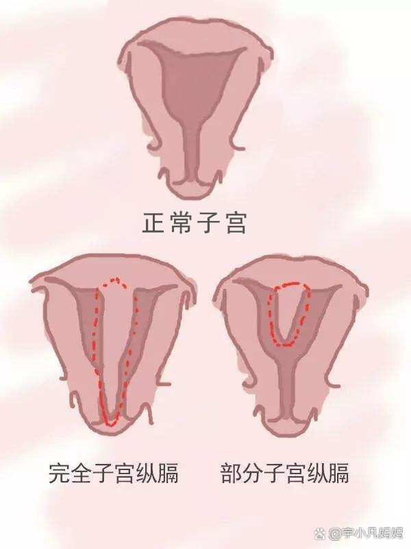 不全纵隔子宫胎儿图片图片