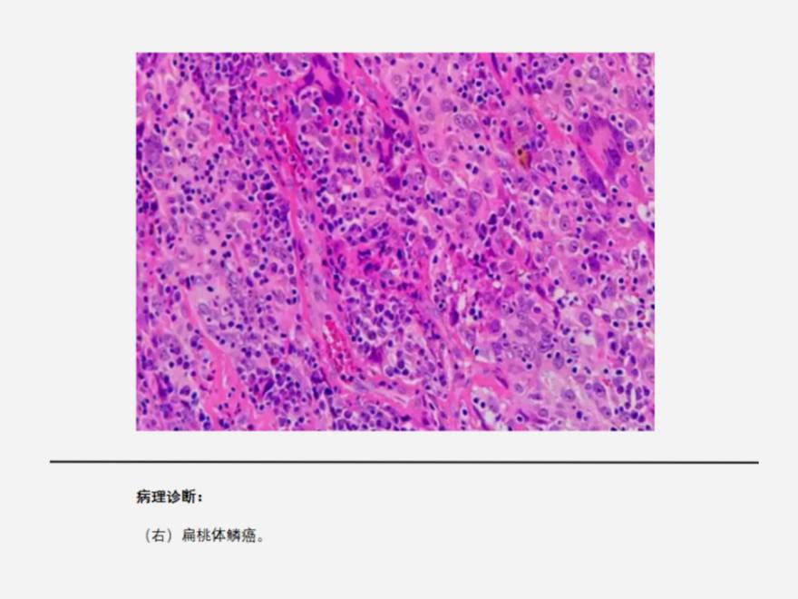 扁桃体鳞癌咽部不适,手术联合放疗效果良好!