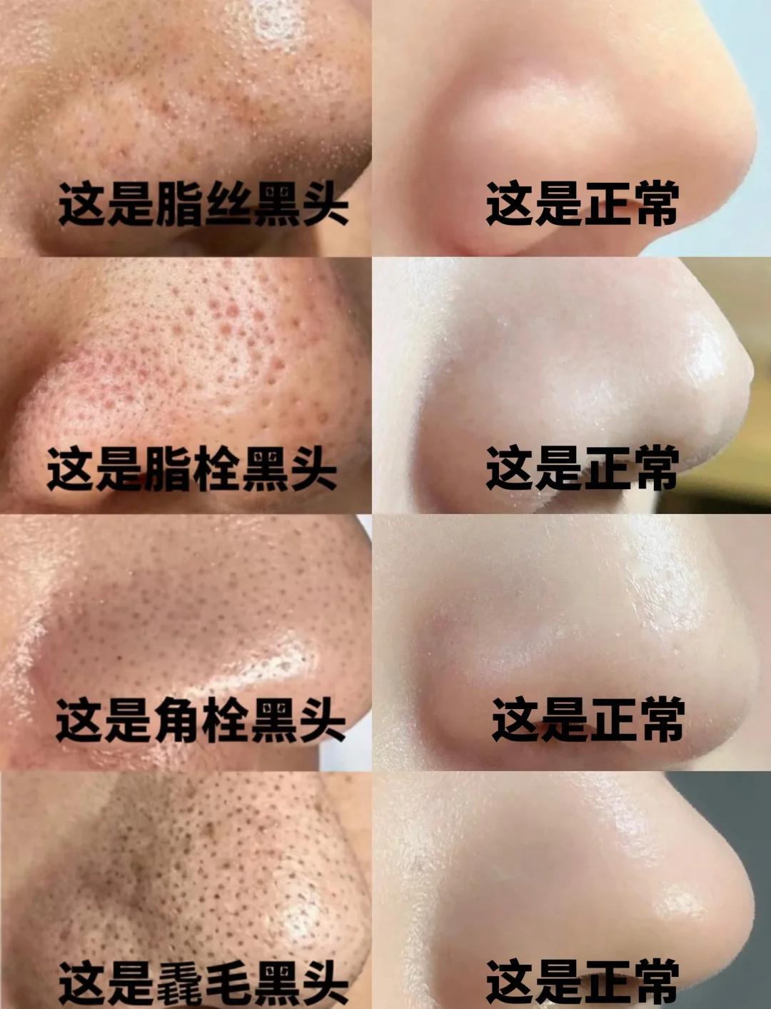 黑头全解析：4种类型及去除方法