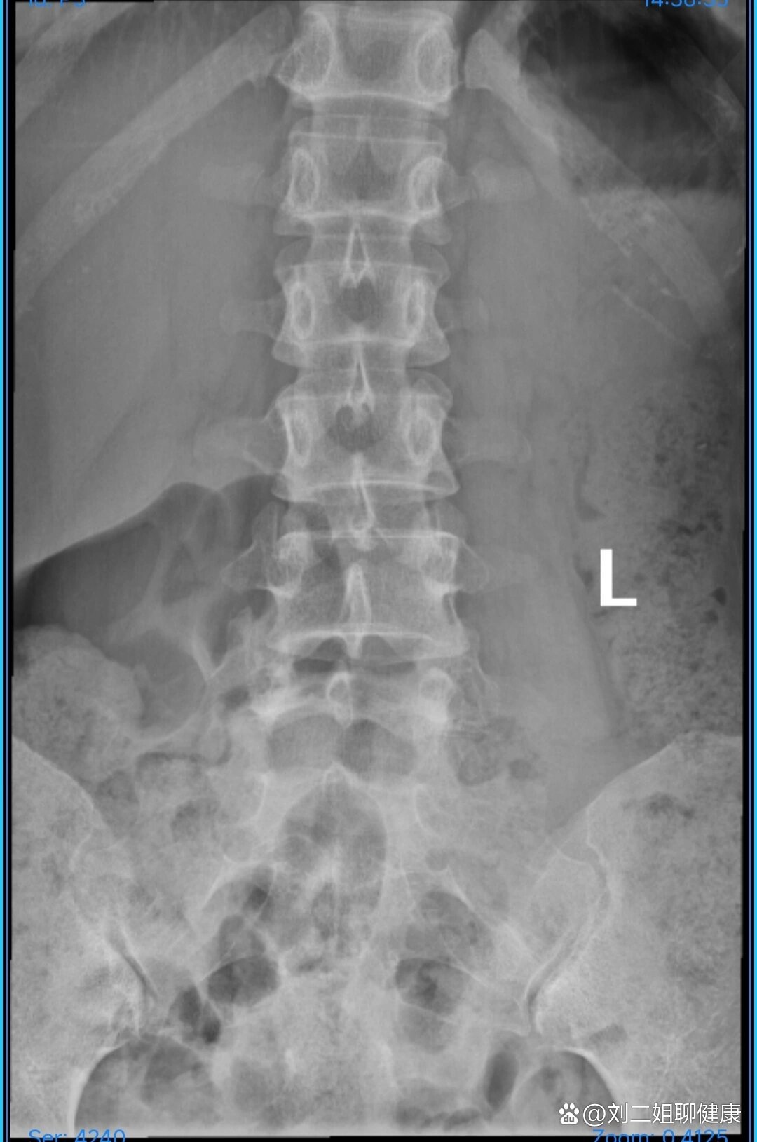 腰椎骶化是个啥
