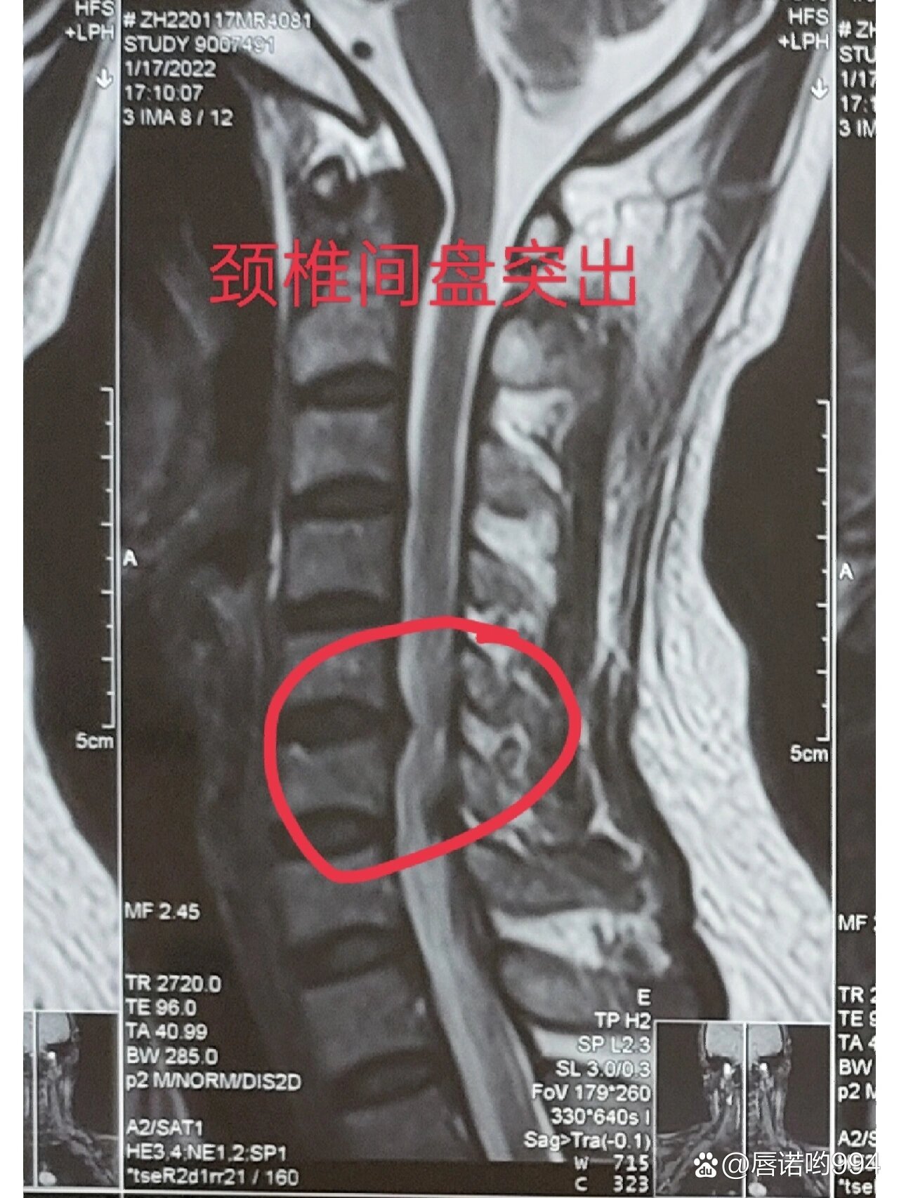 颈椎磁共振图片详解图片