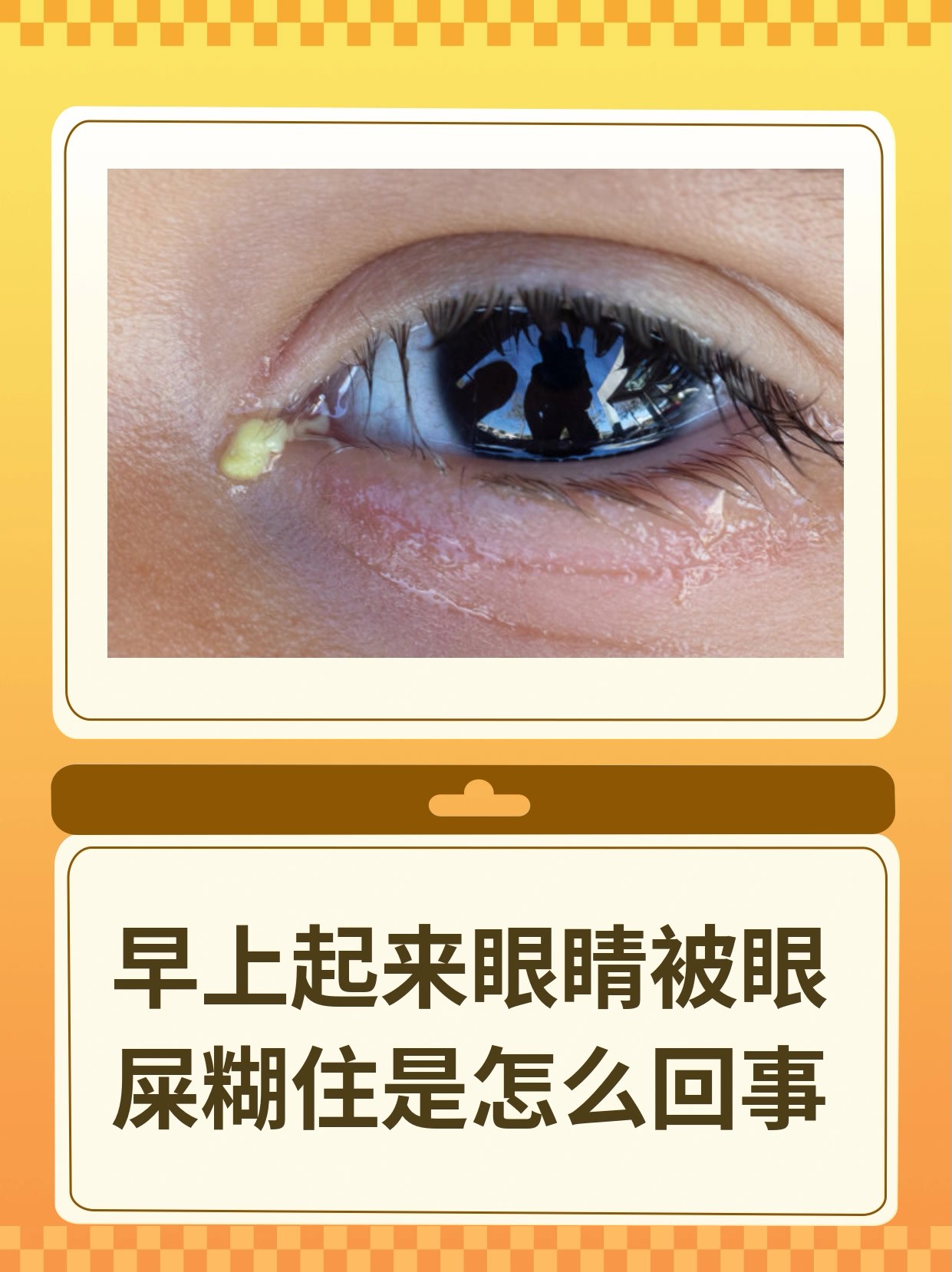 早上起来眼睛被眼屎糊住是怎么回事