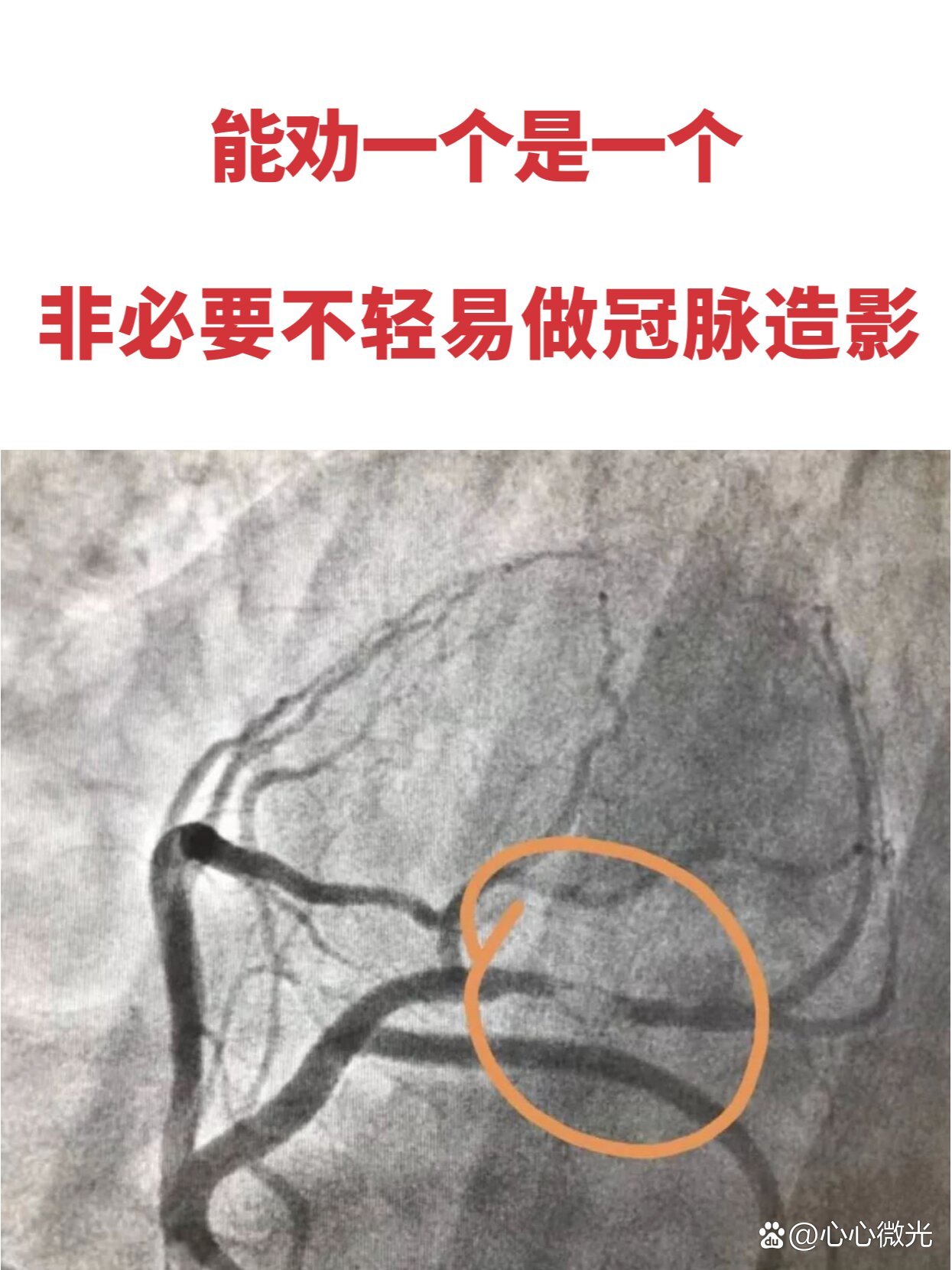 能劝一个是一个非必要不轻易做冠脉造影