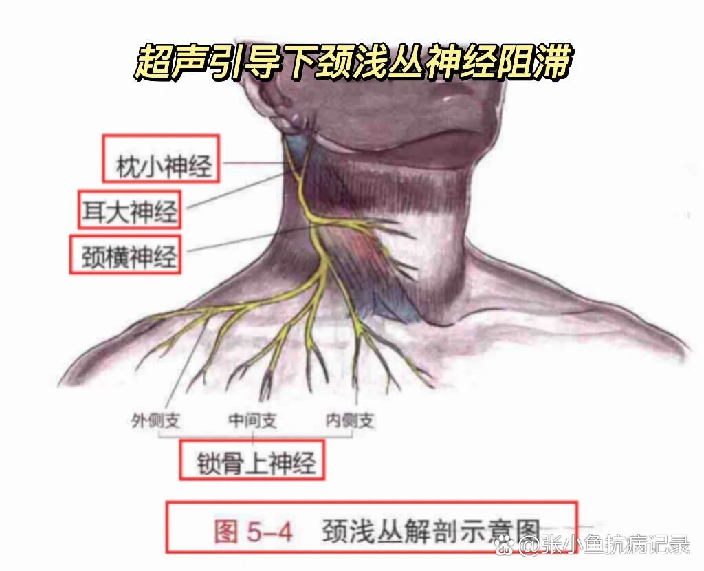 颈丛阻滞法定位图图片