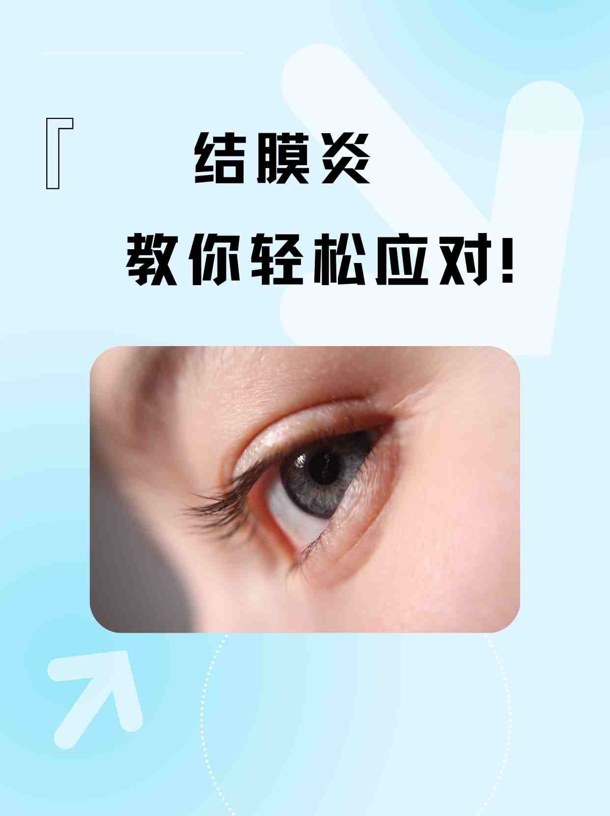 结膜炎自愈秘诀:教你轻松应对!
