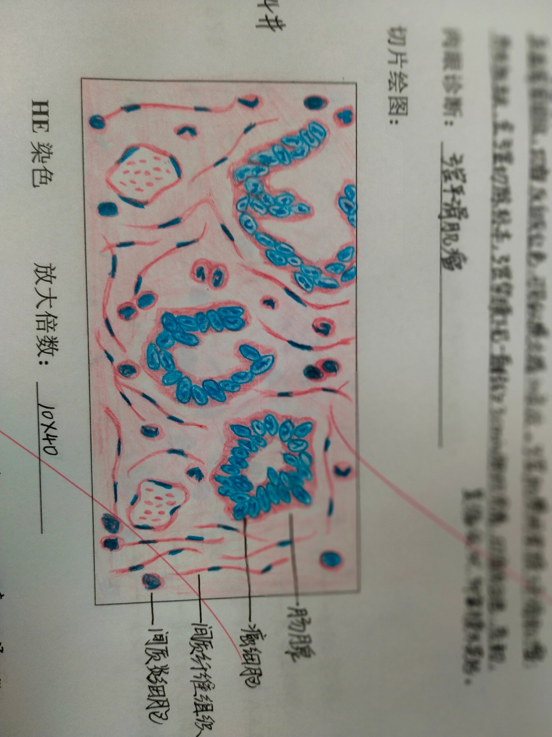 绒毛膜癌病理手绘图图片