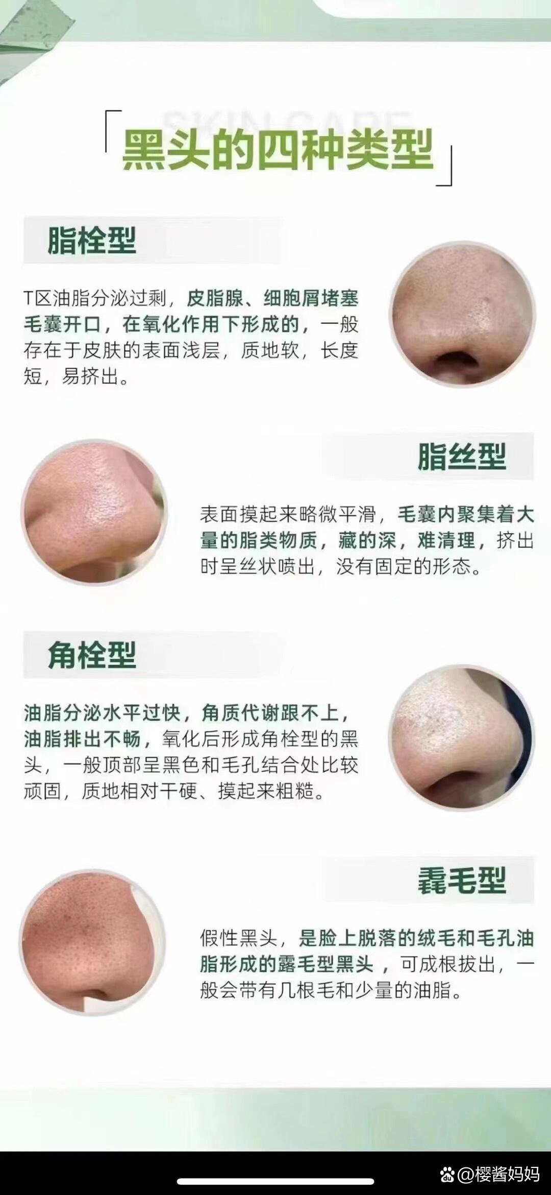 黑头的四种类型