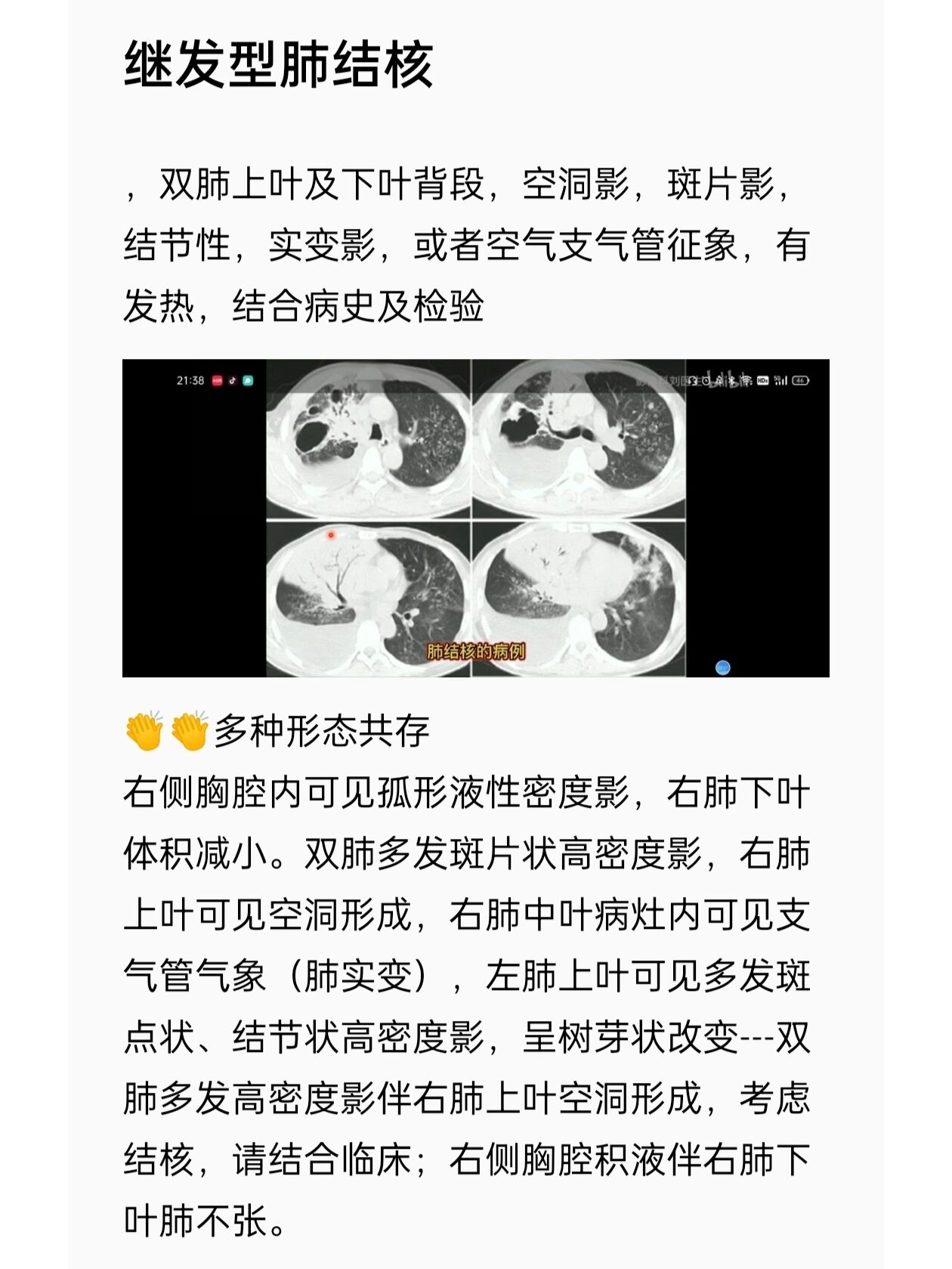 肺结核影像学表现:多形性