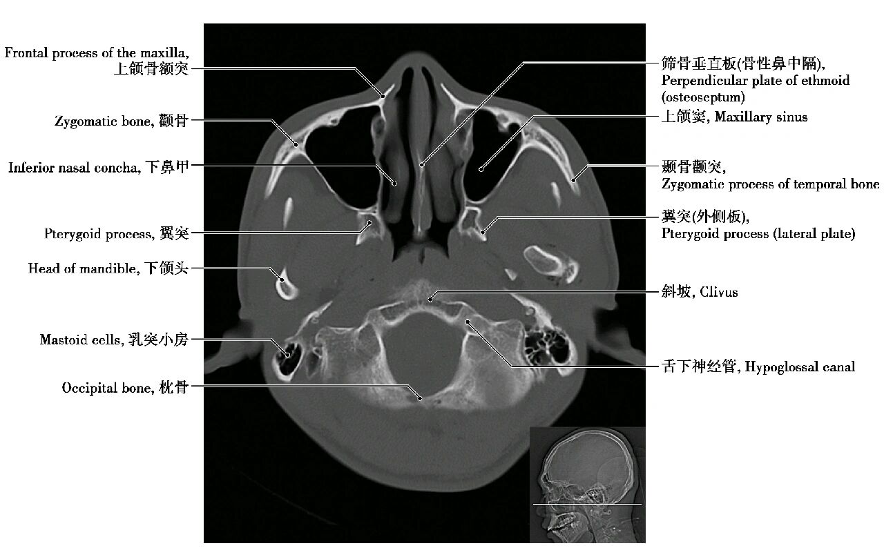 颅底ct断层解剖骨窗图片