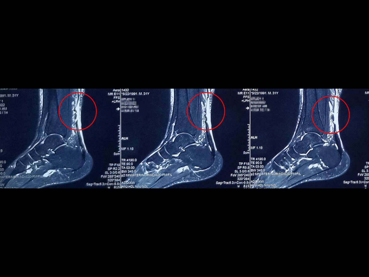 跟腱断裂ct图图片
