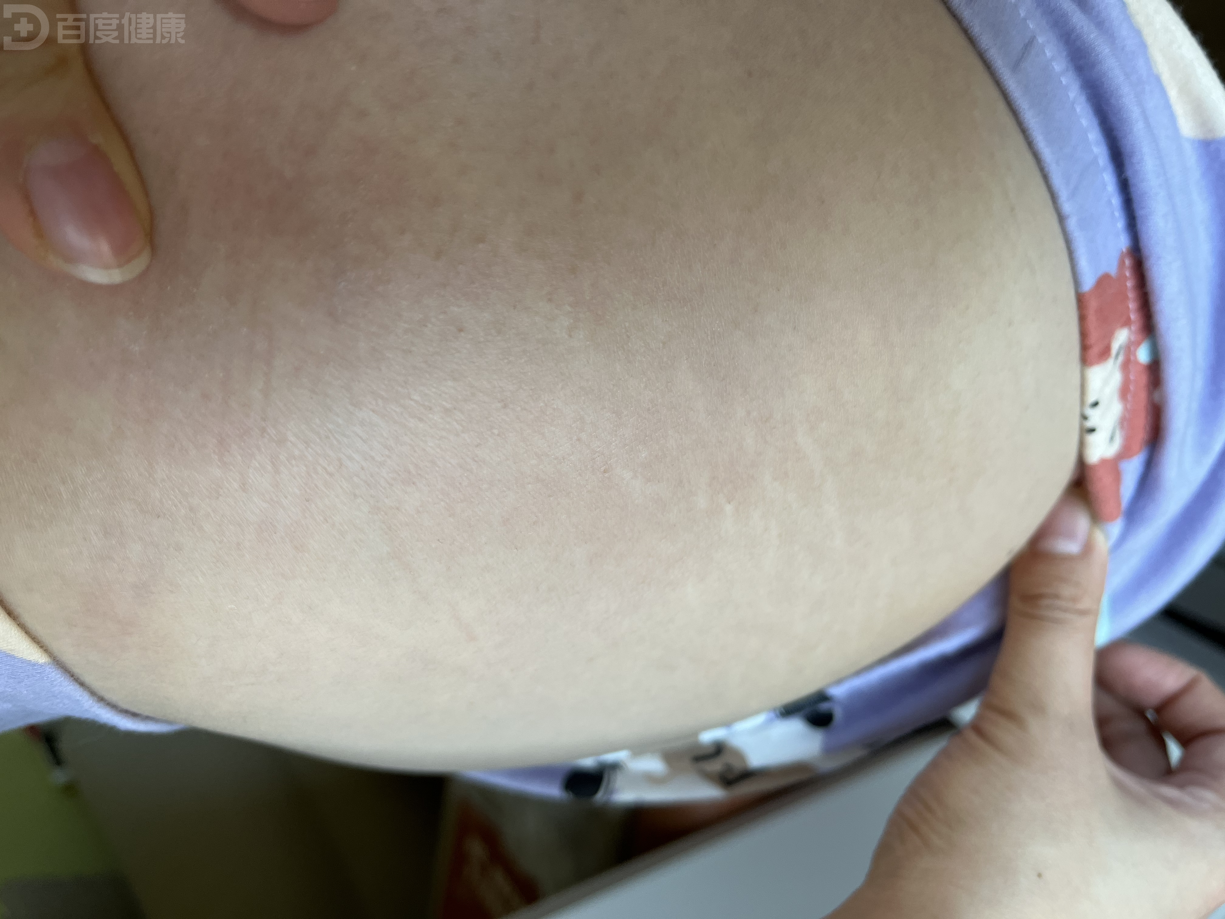 30岁女性有萎缩纹,药物即改善症状