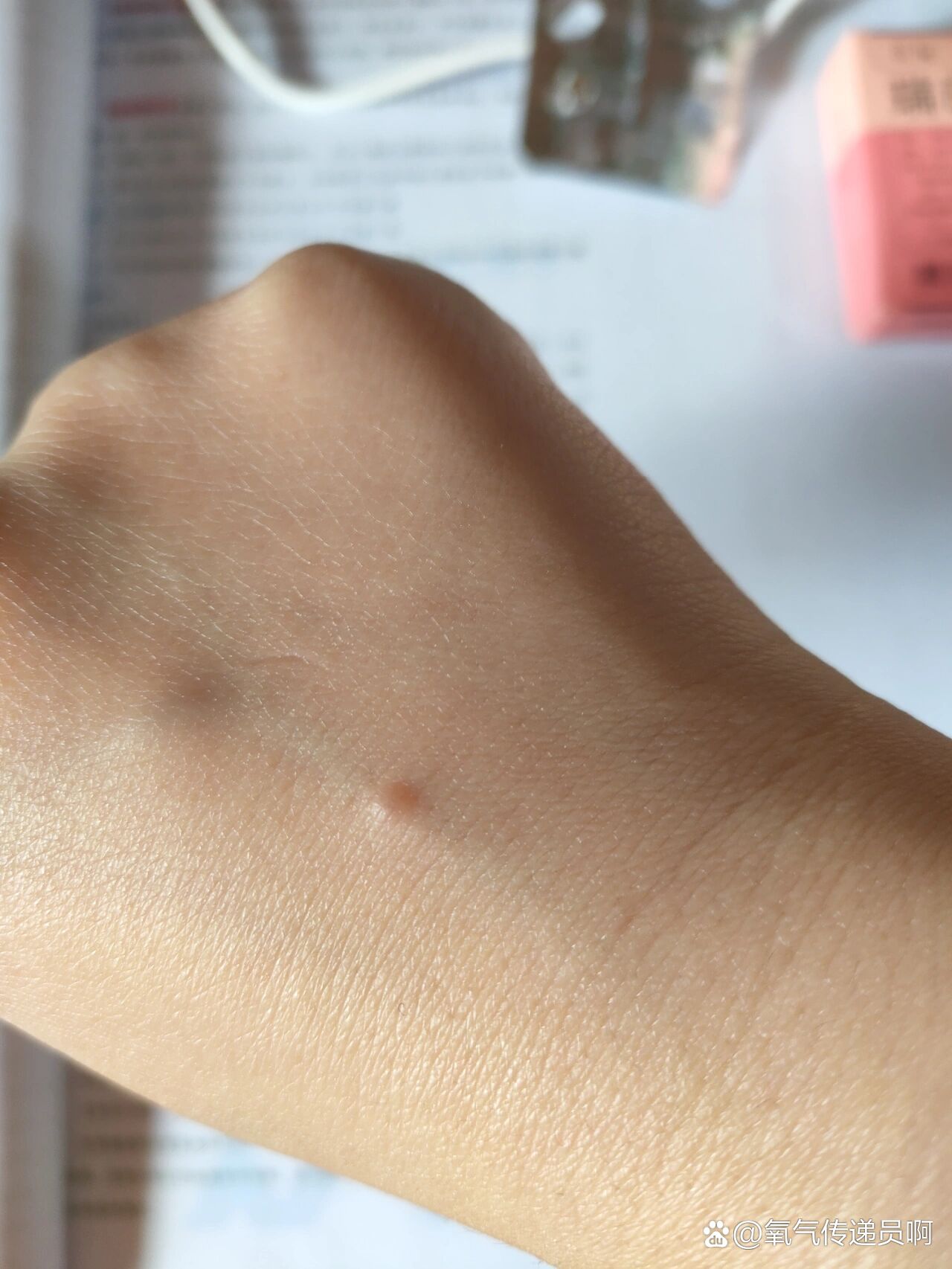 打完吊瓶以后有个小鼓包一直没消是咋回事呀