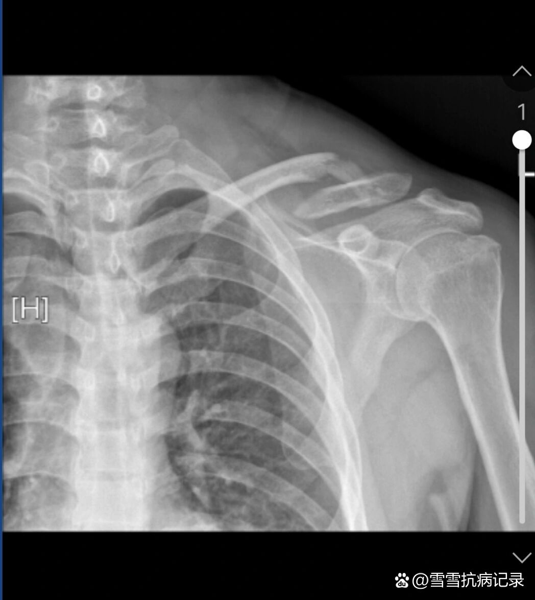 锁骨骨折片子图片