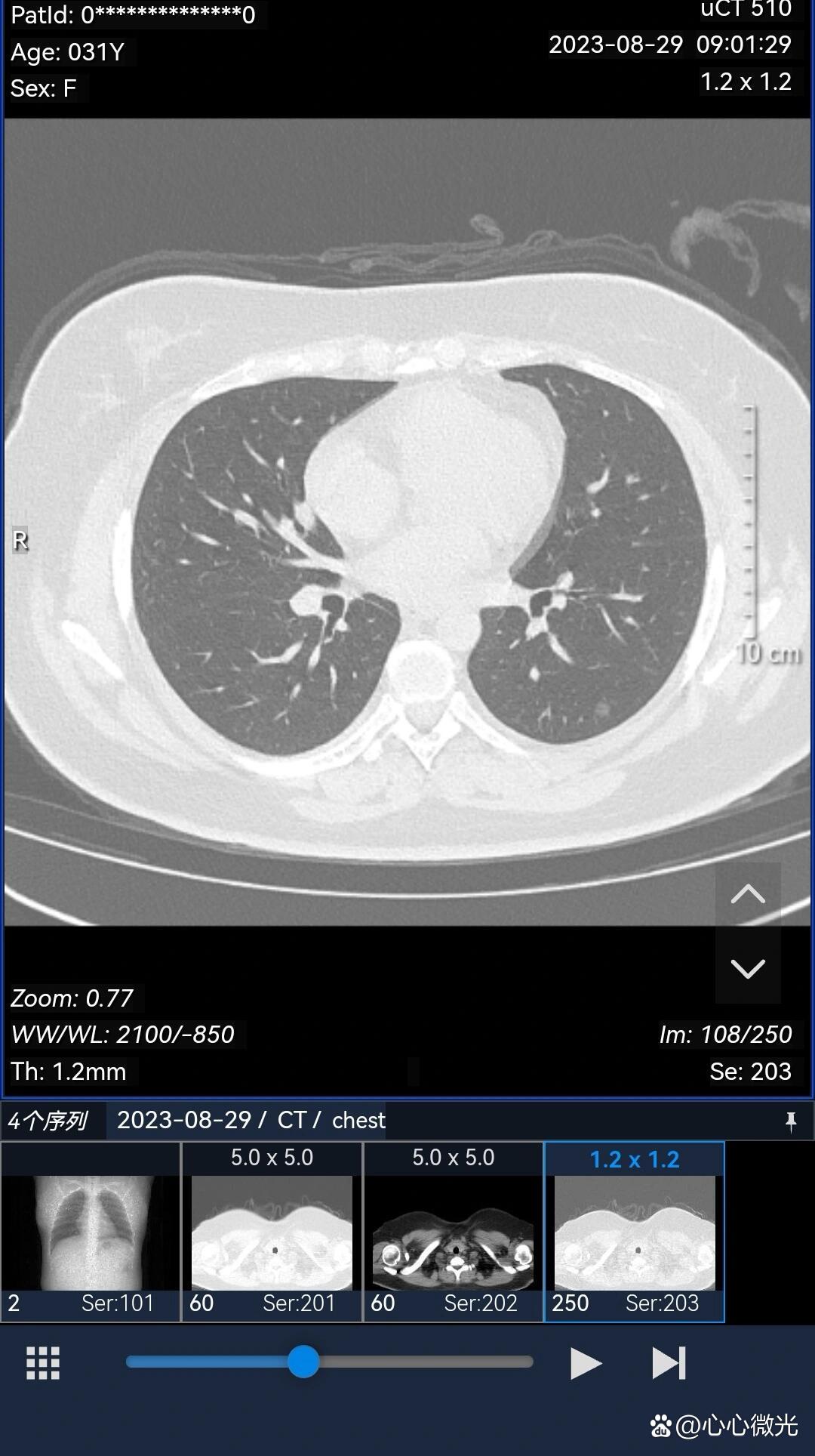 混合磨玻璃结节,就医经历