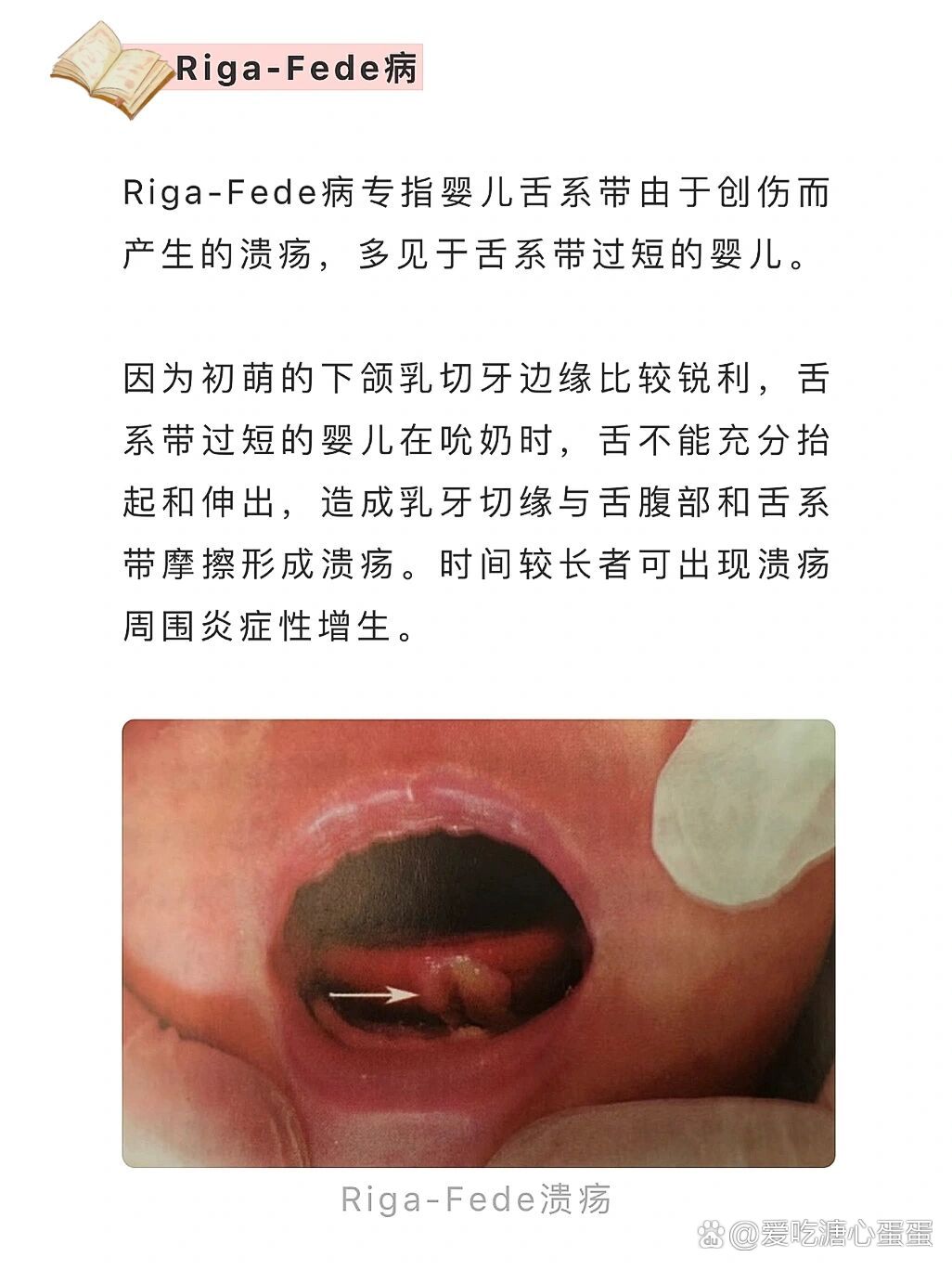  舌系帶剪斷的利弊_舌系帶剪斷的利弊有哪些