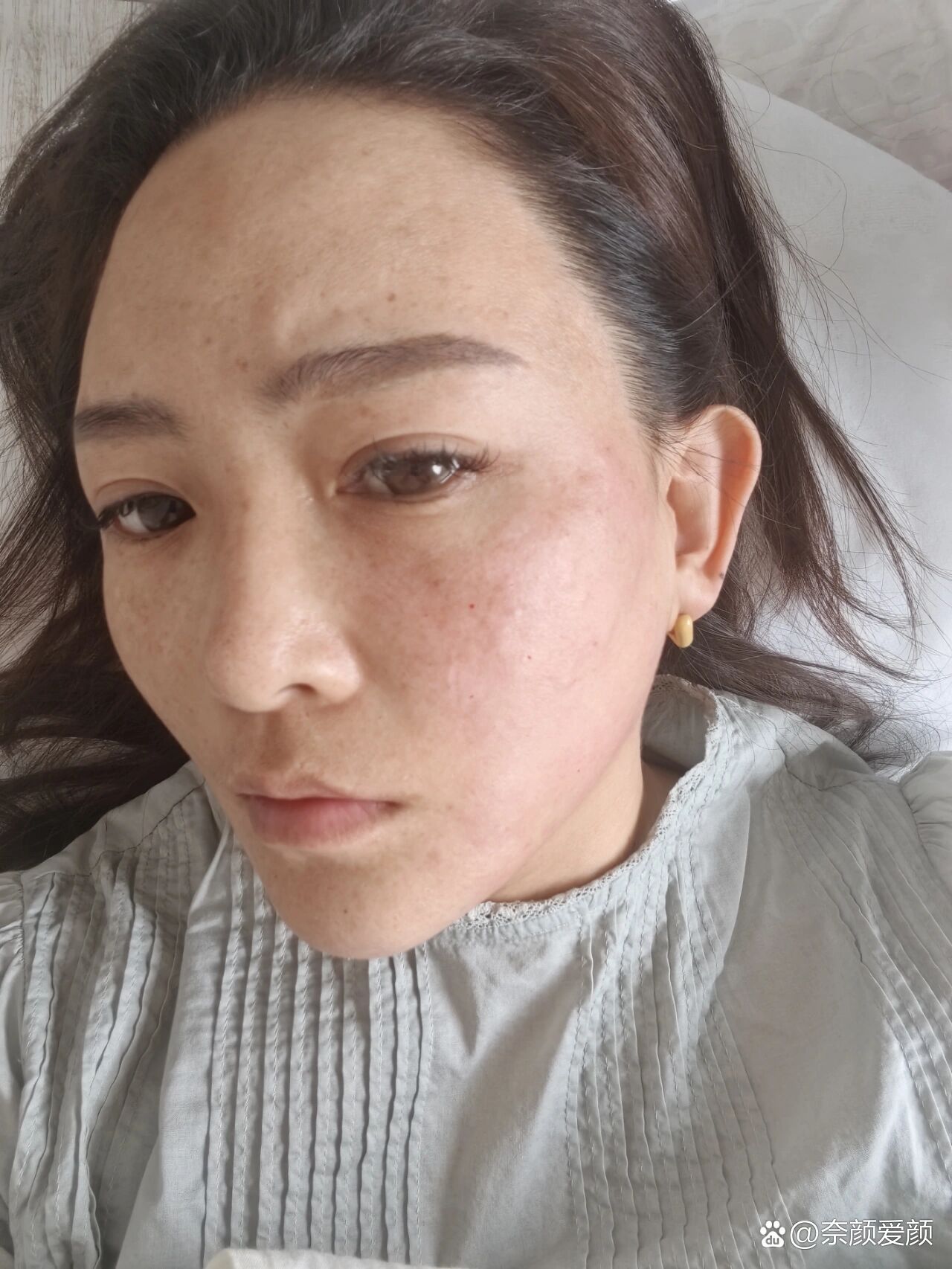 帝美尼提升针,打了第二次了