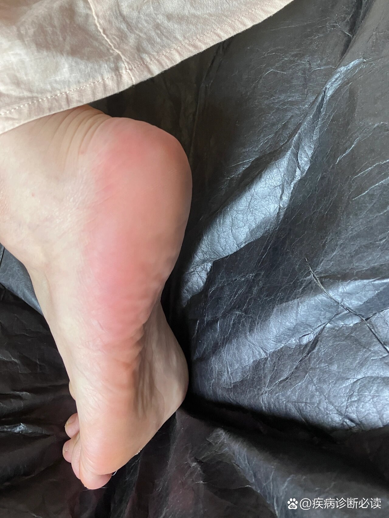 脚后跟粗糙龟裂得救了
