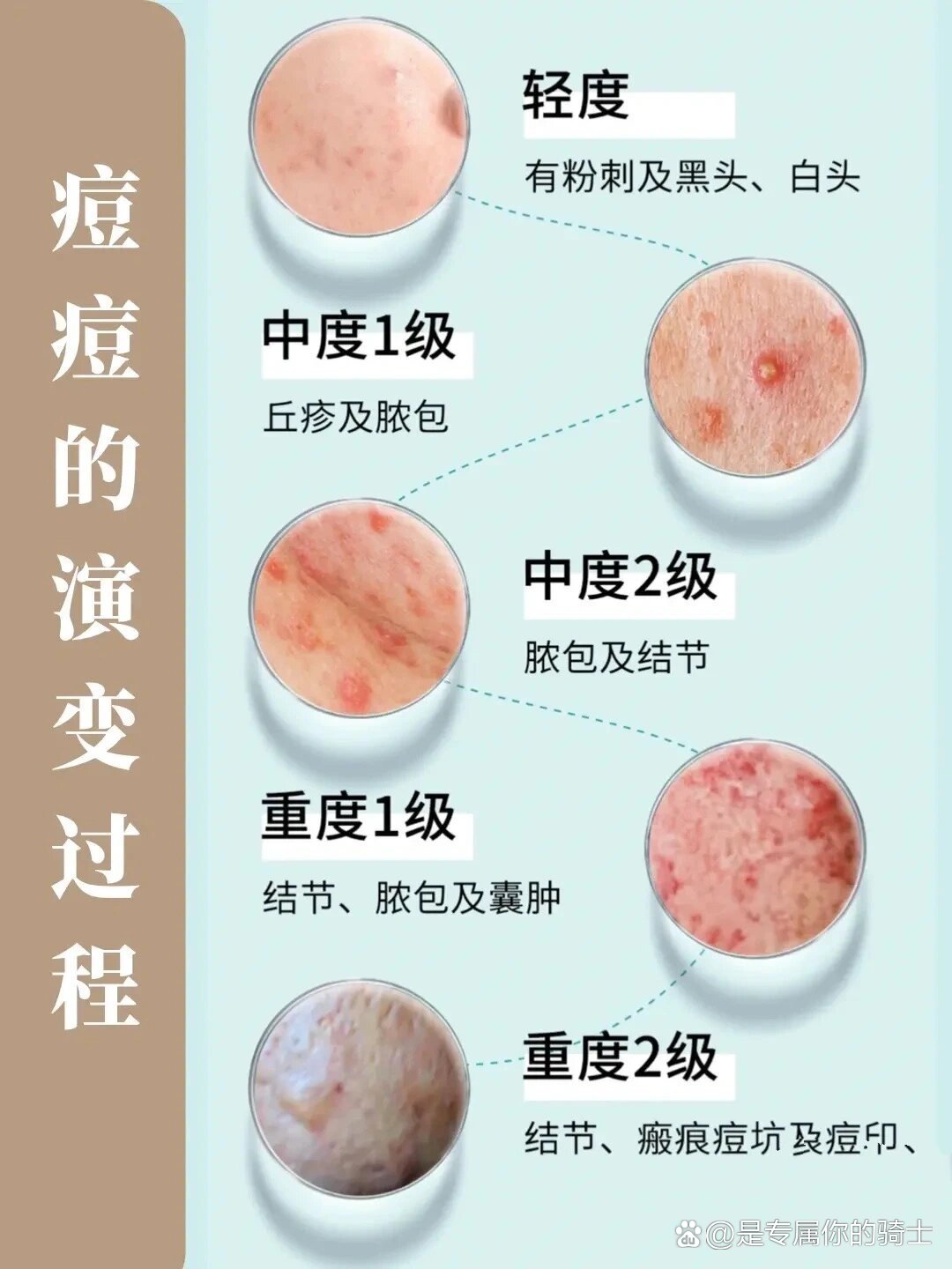 不同阶段痘痘演变过程