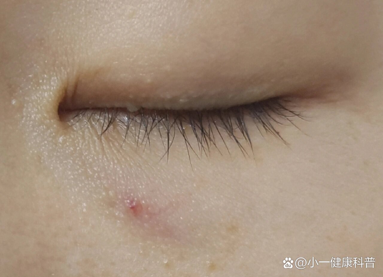 眼下皮肤有红色的淤血点