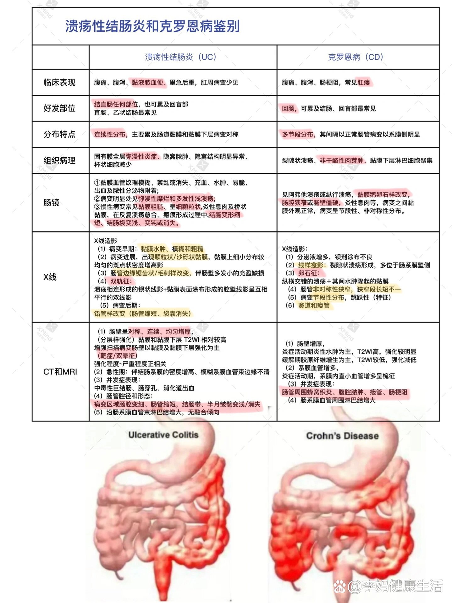 溃疡性结肠炎vs克罗恩病|附肠镜图和病历