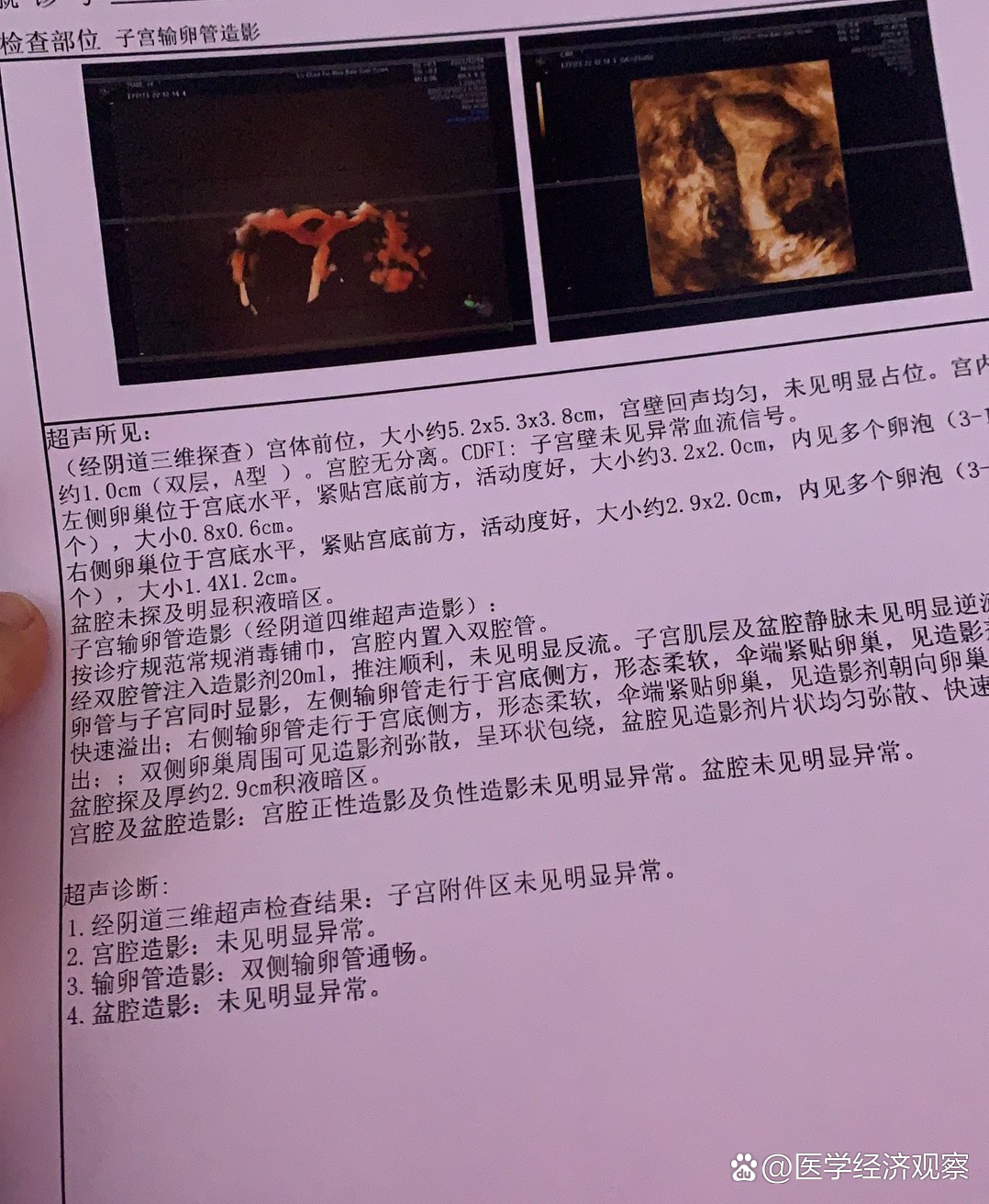 超声输卵管造影检查