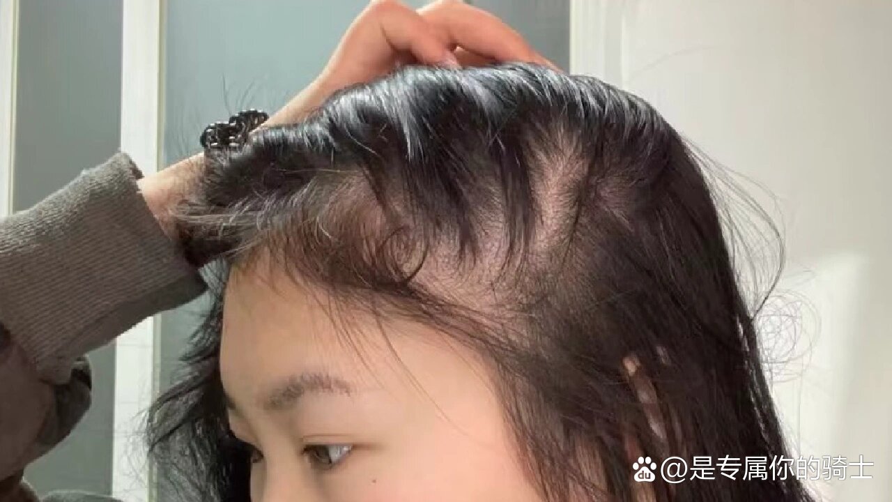 侧面头发稀疏脱发严重