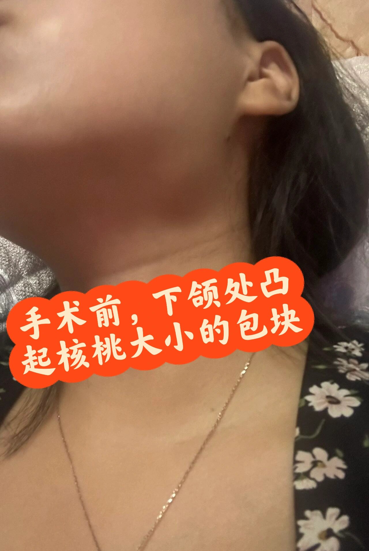 有一个核桃大小的可移动,无痛感的硬块,去医院拍彩超确诊为颌下腺腺瘤