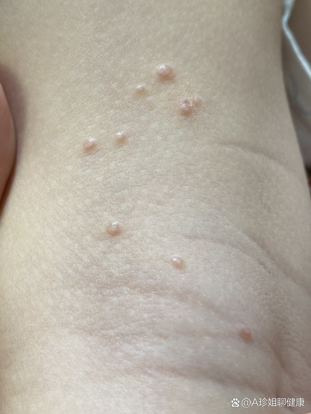 传染性软疣青睐儿童