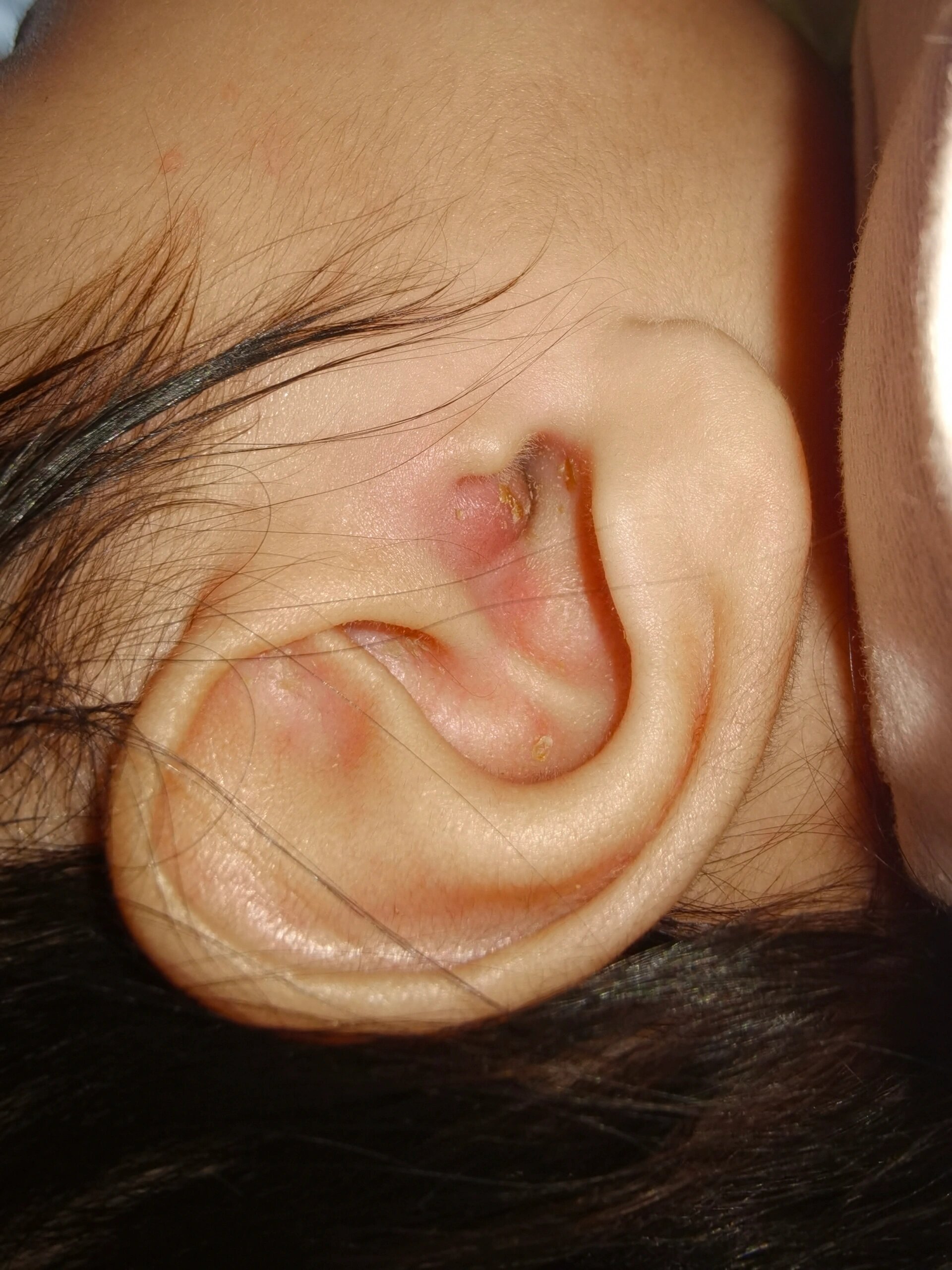 3月龄小宝宝耳朵肿包怎么办