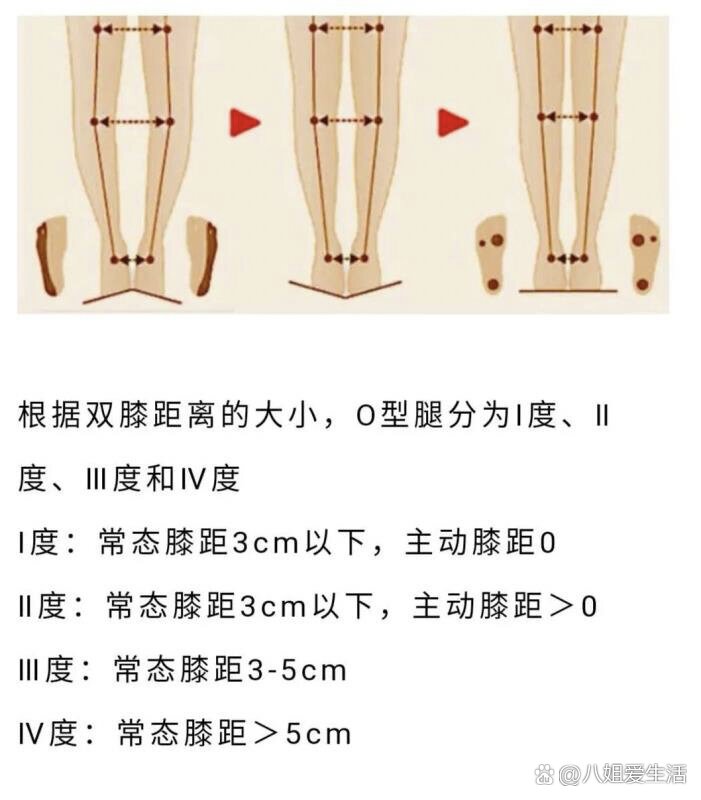  p>98看下你的o型腿严重程度7515附改善动作8215 br>95膝