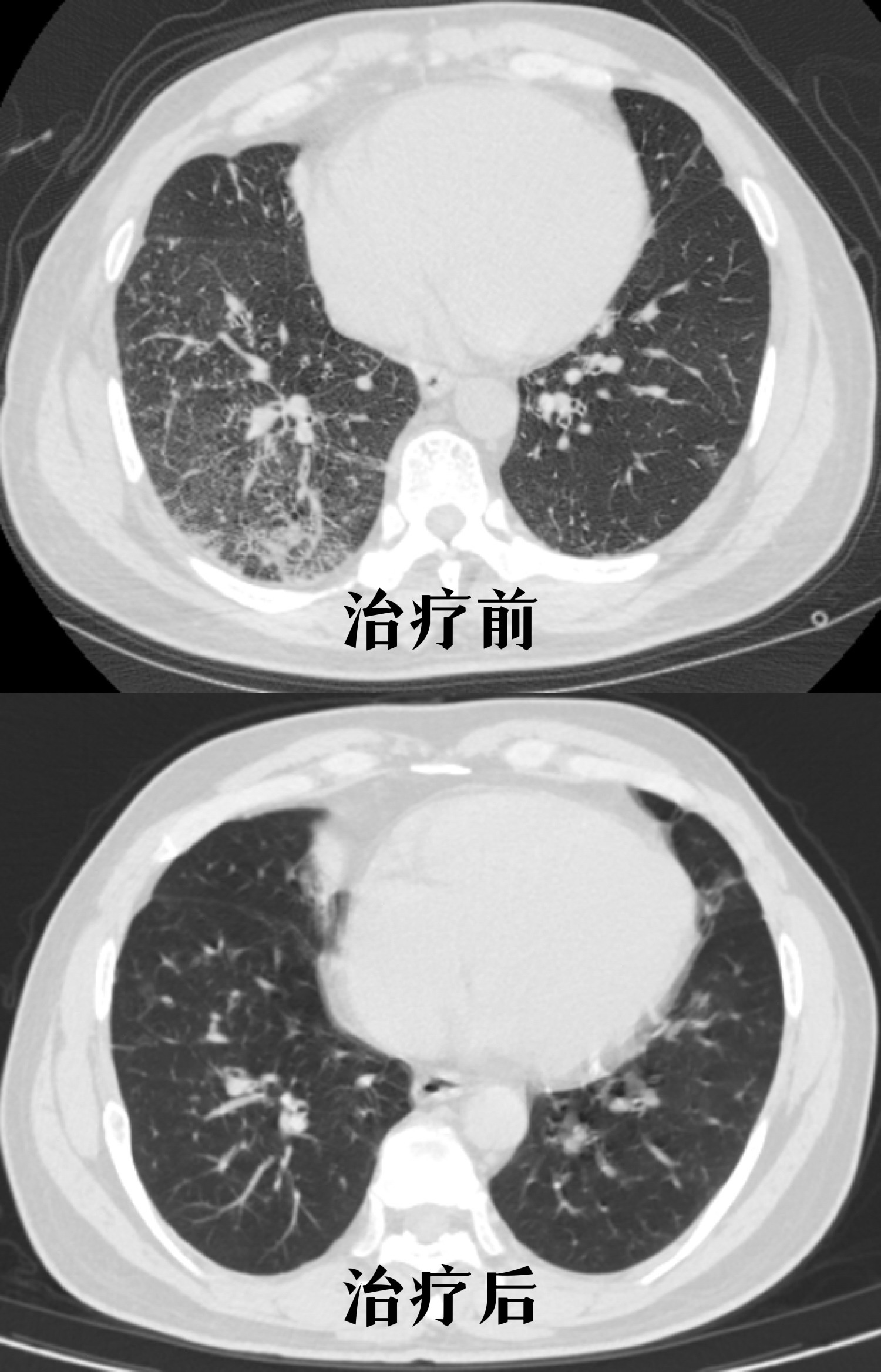 细菌性肺炎查不出致病菌,广谱抗生素显奇效