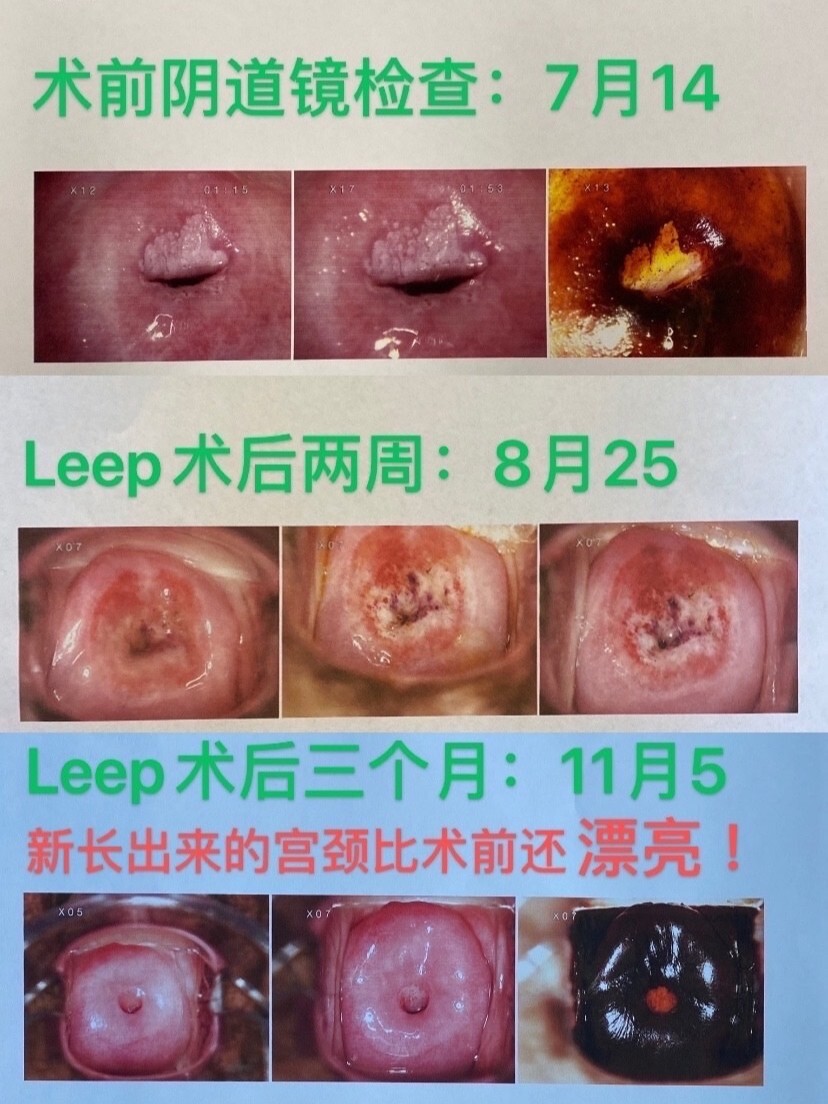 leep术后三个月--新长出来的宫颈更好看了