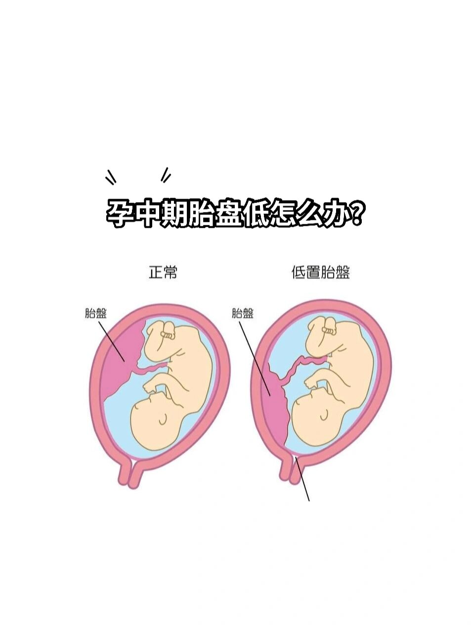 胎盘低置有感觉吗?