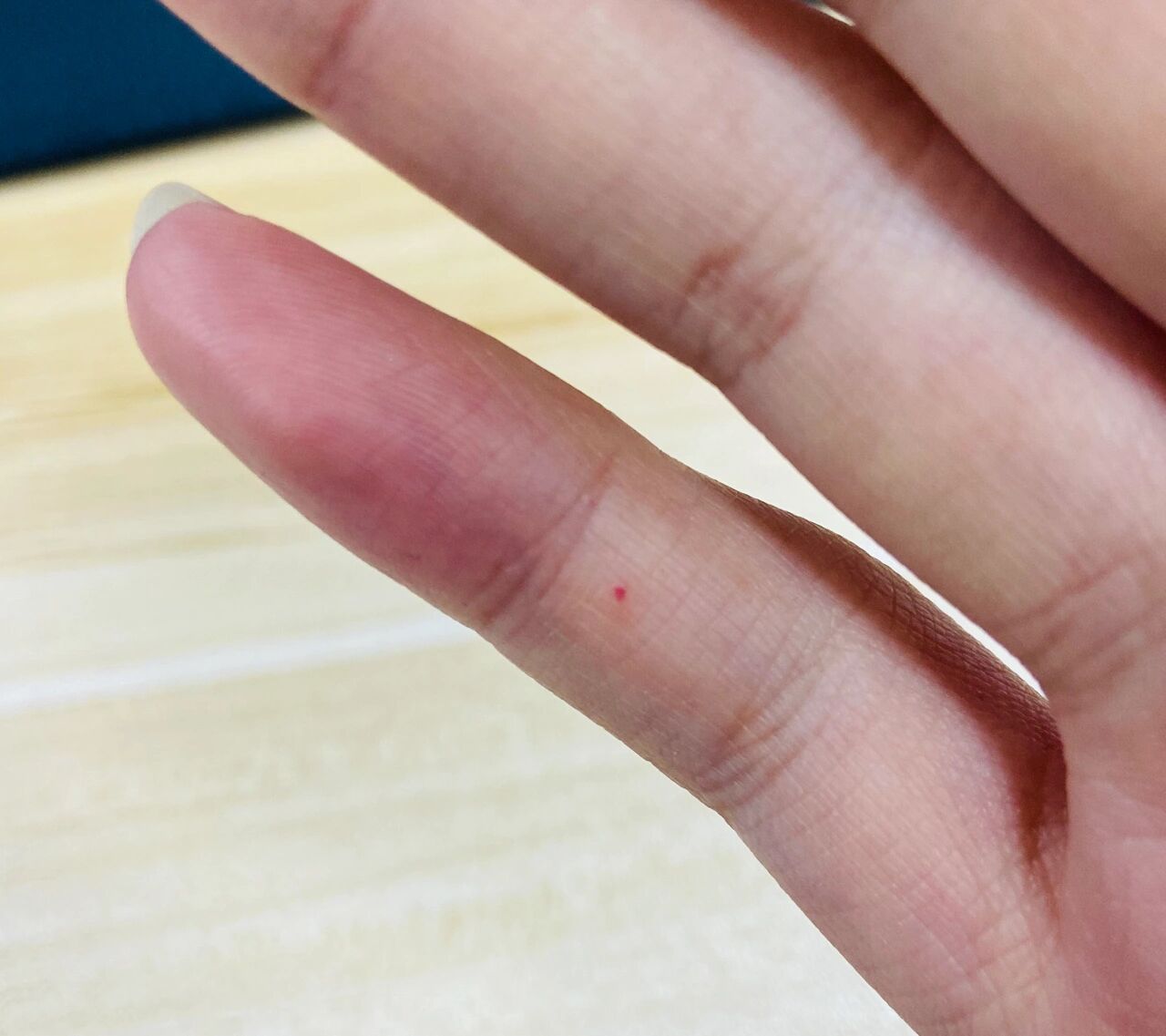 手上长小红点最初手指长一个小红点,一按就没了,一会儿自己又