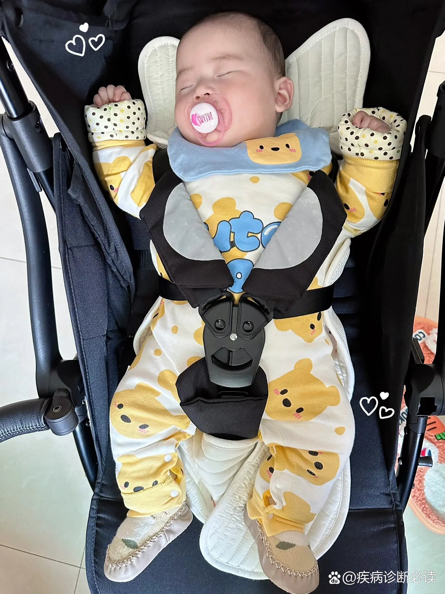 肝素宝宝(抗磷脂综合症)