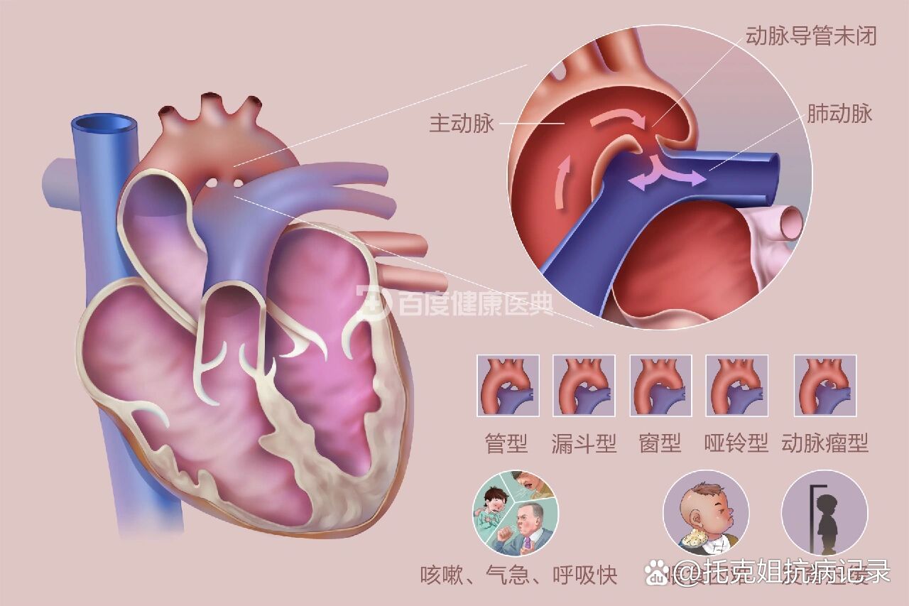 动脉导管未闭漏斗征图片