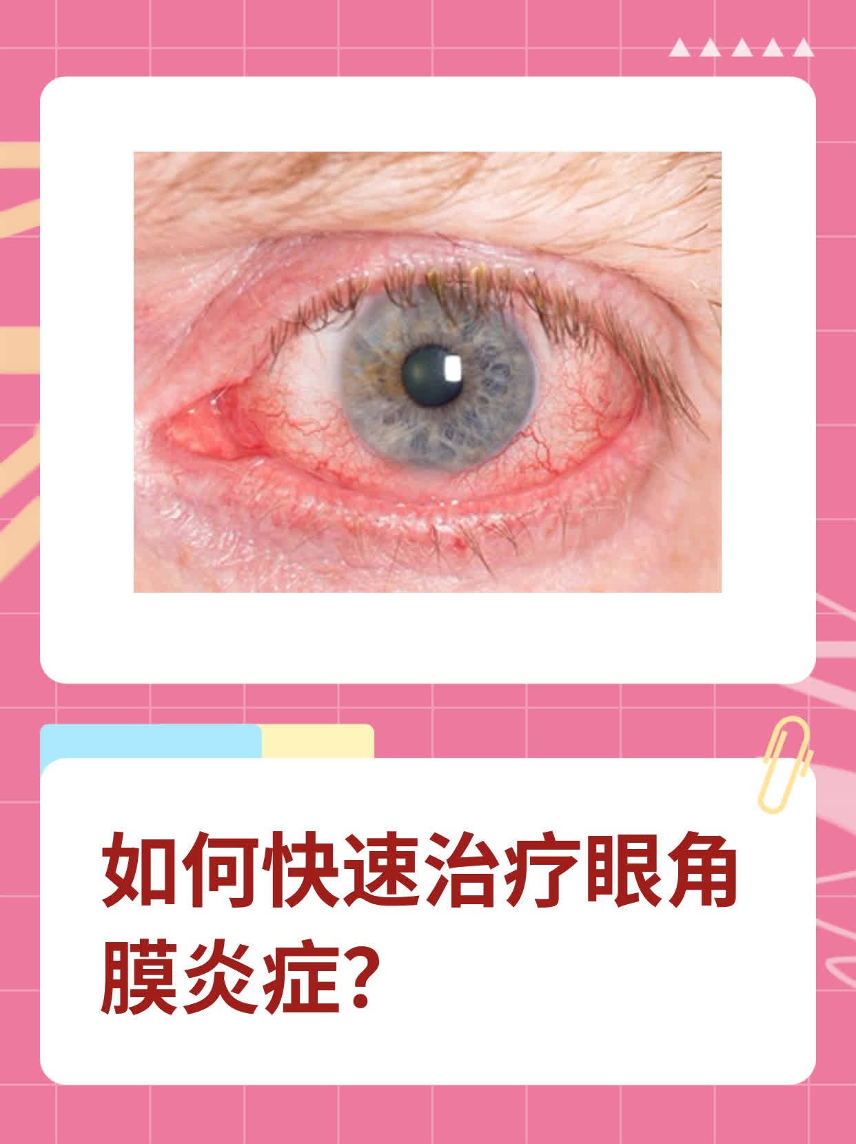 如何快速治疗眼角膜炎症