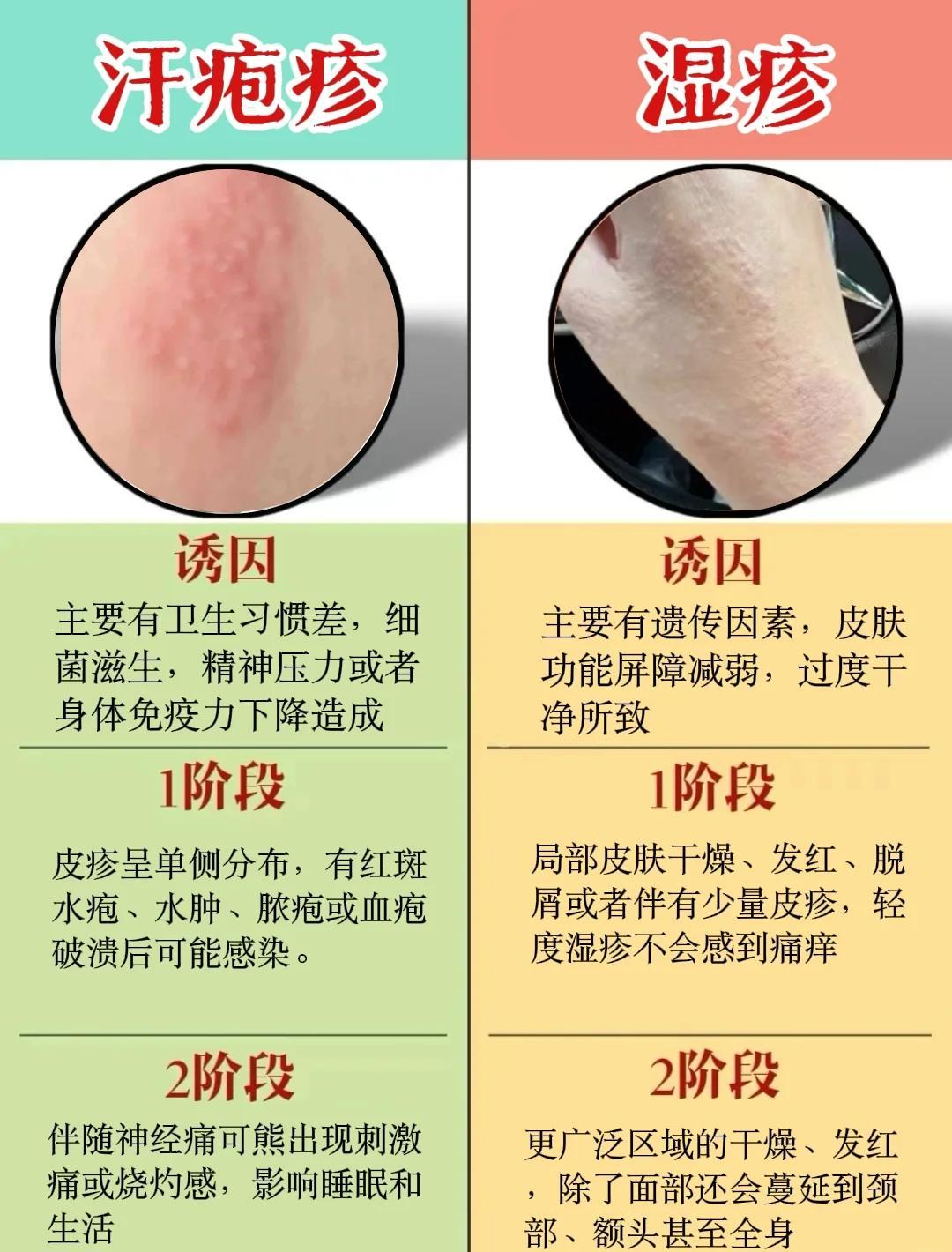 疱疹与湿疹的区别及治疗