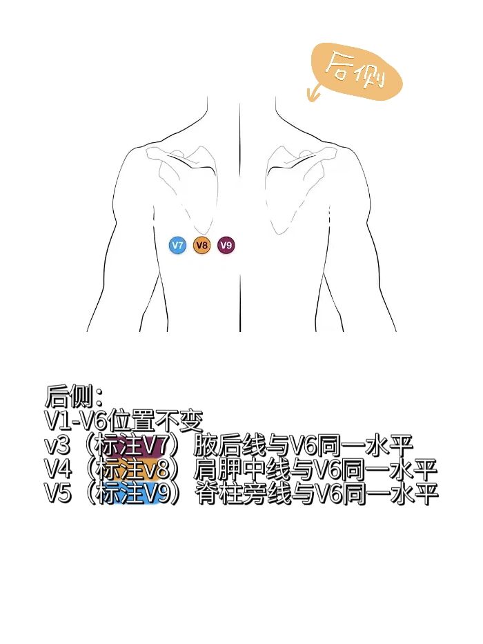 十八导心电图颜色位置图片