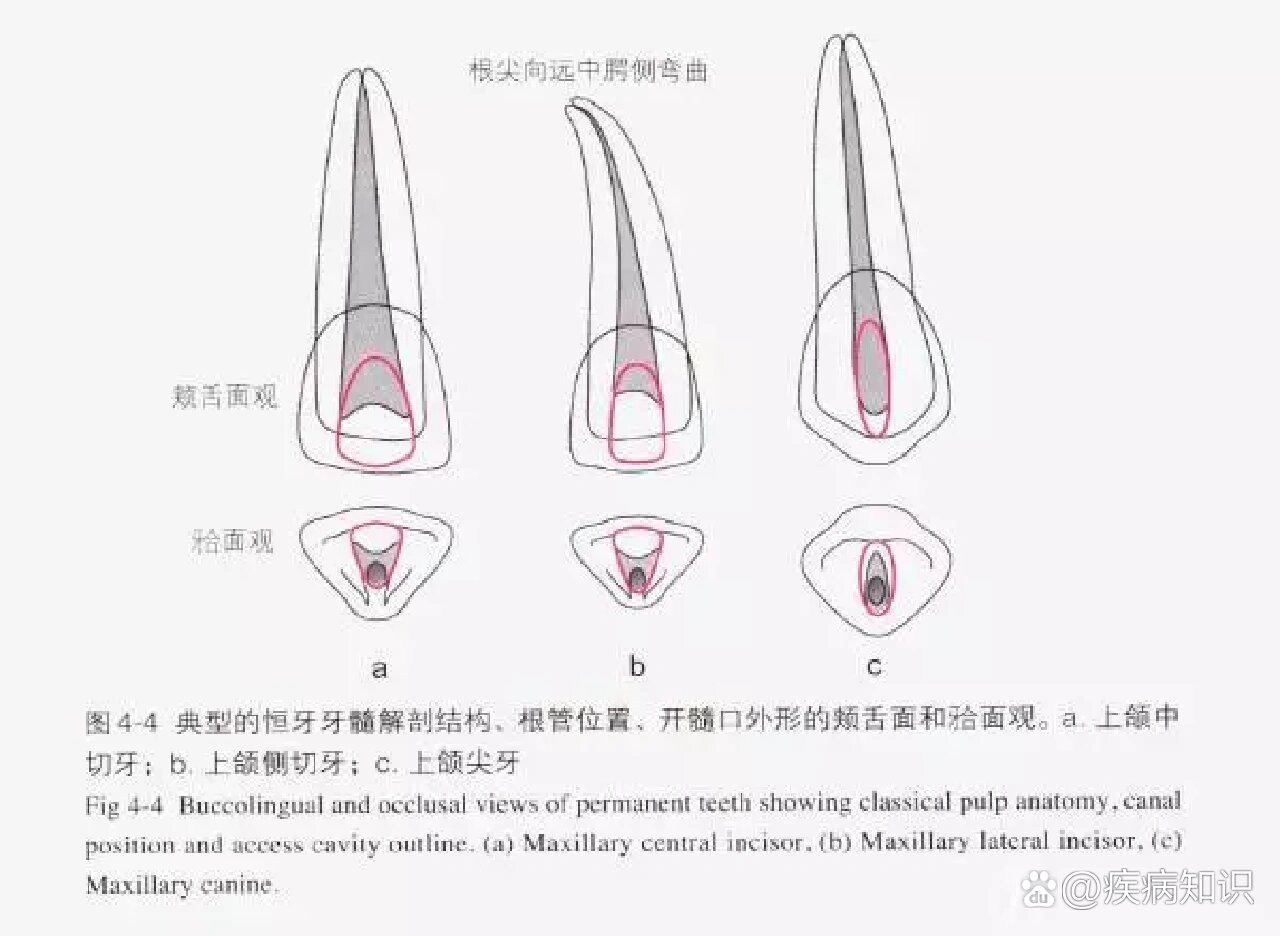 下颌六的开髓形态图片图片