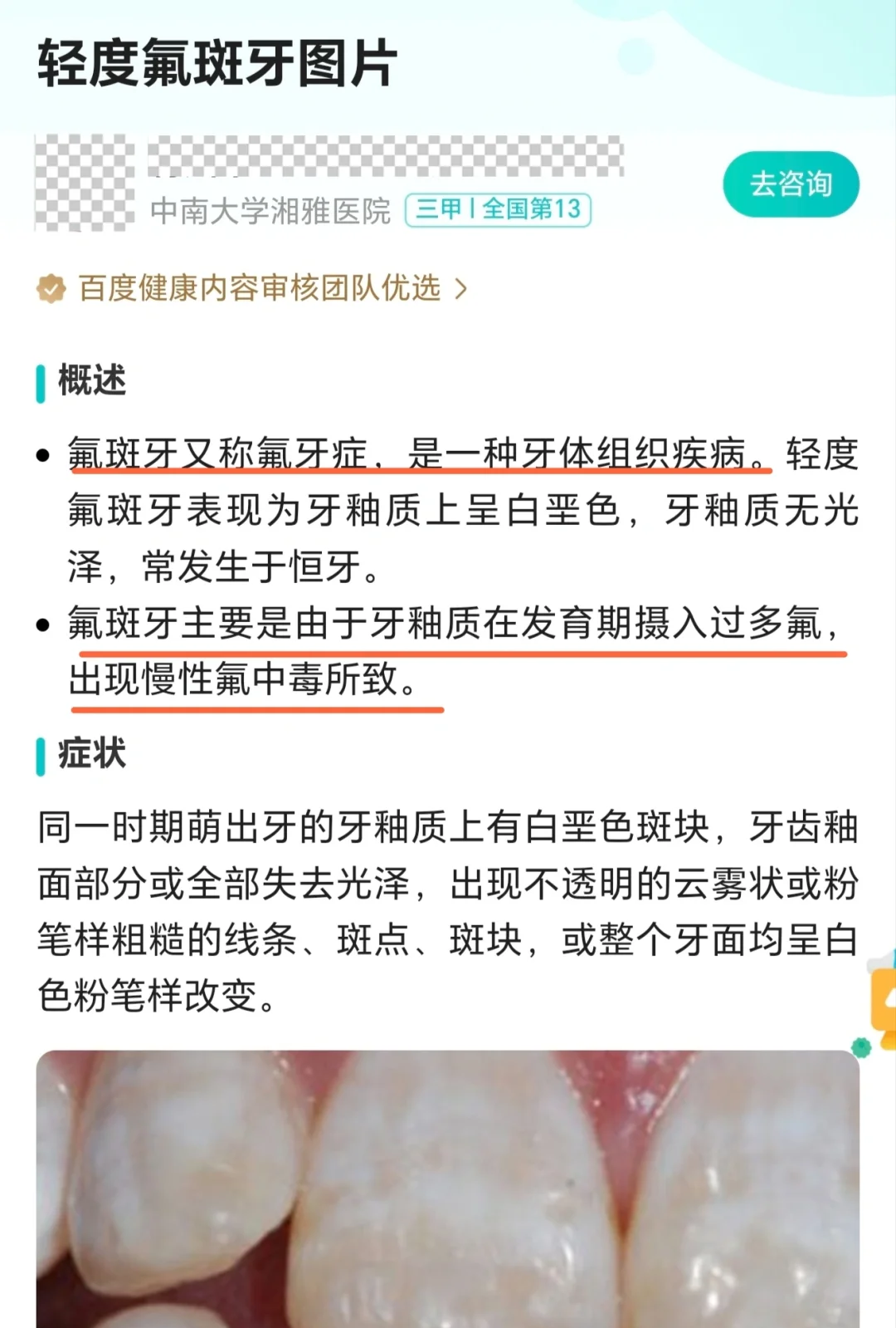 含氟牙膏的潜在危害，你真的了解吗？