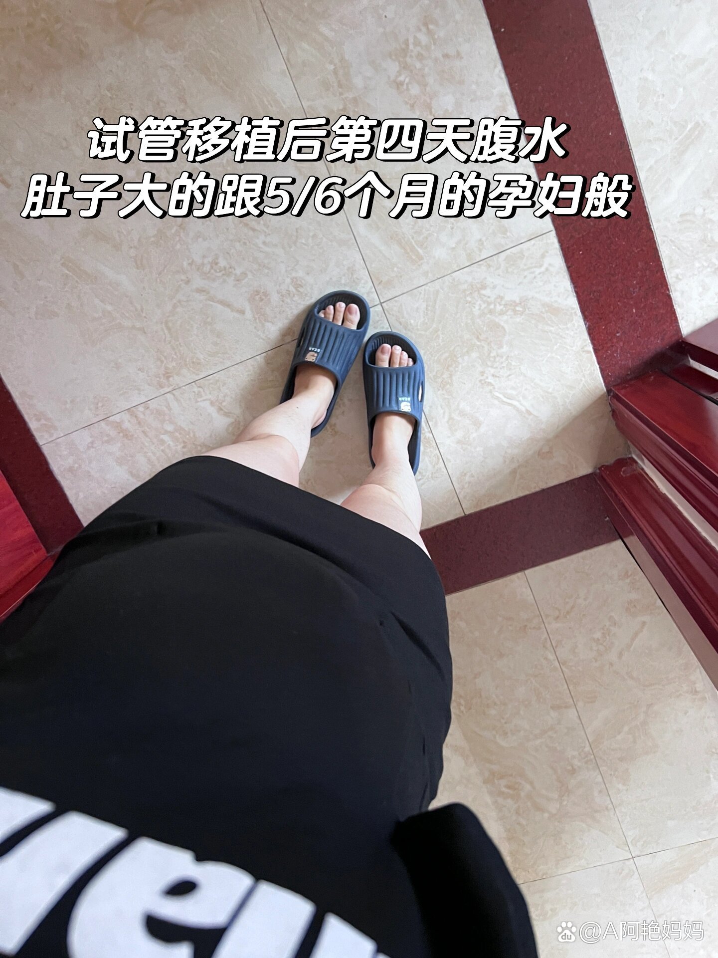  p>试管移植后第四天腹水 br>姐妹们,我躲过了取卵后的重度腹水,却没