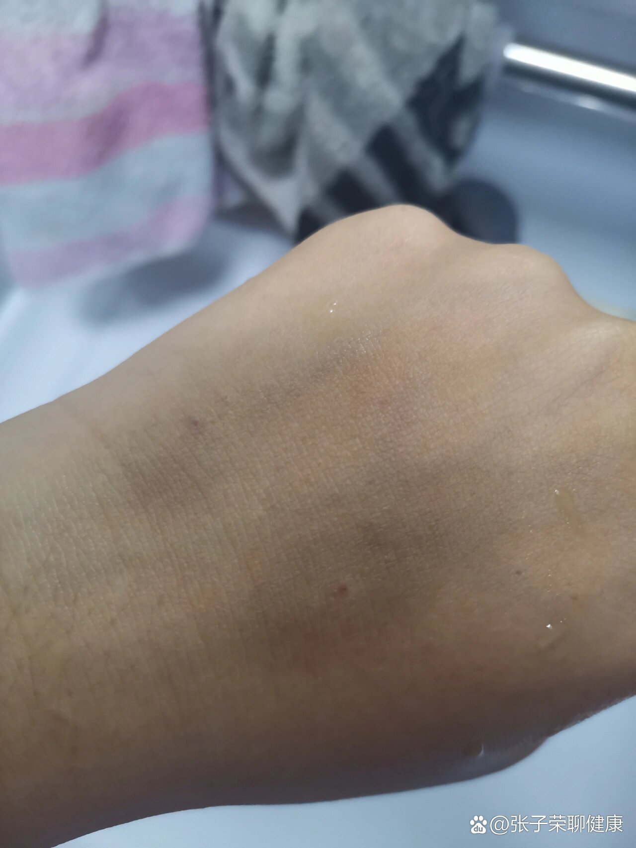 挂水挂的手都青了呜呜呜