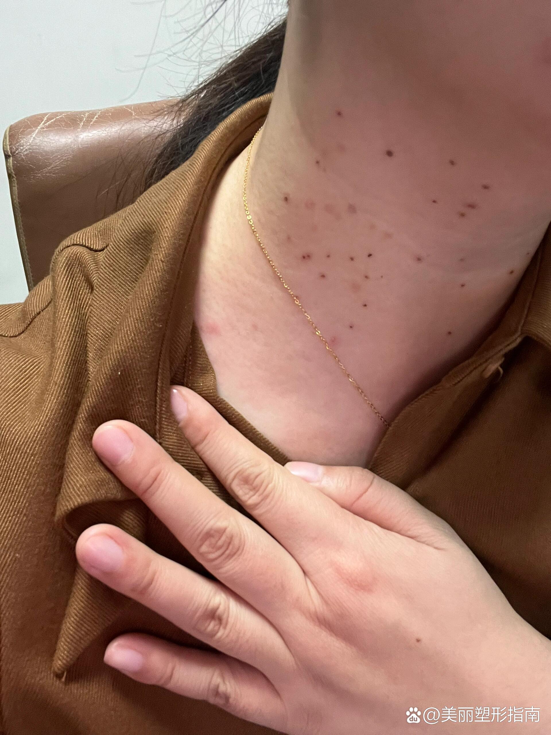 激光点疣第五天