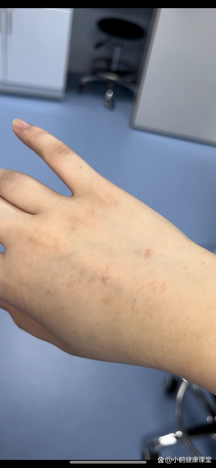 洗手太多次了,导致太干,手背好多红点
